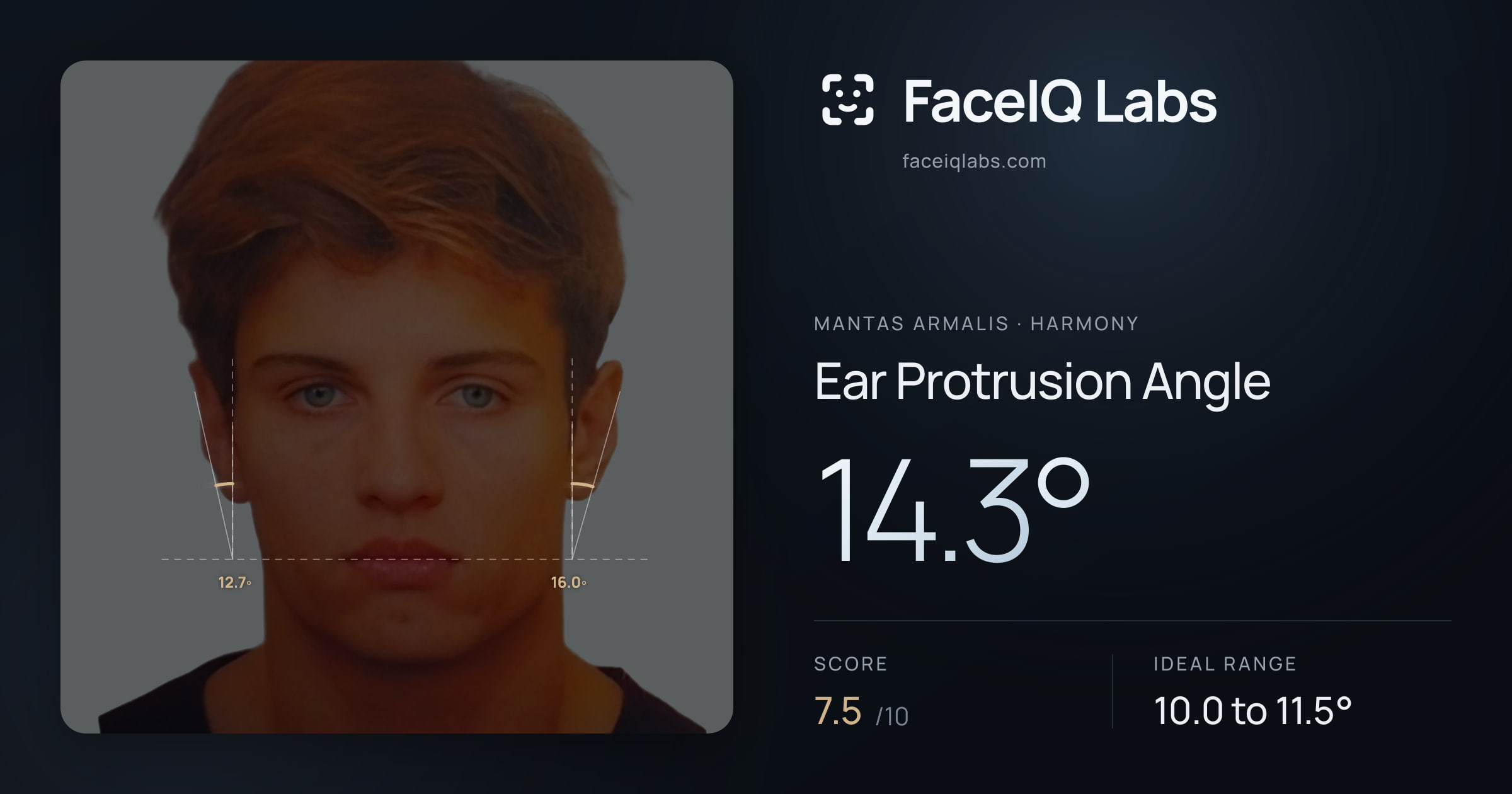 Mantas Armalis Ear Protrusion Angle: 14.3°, drawn on the photo