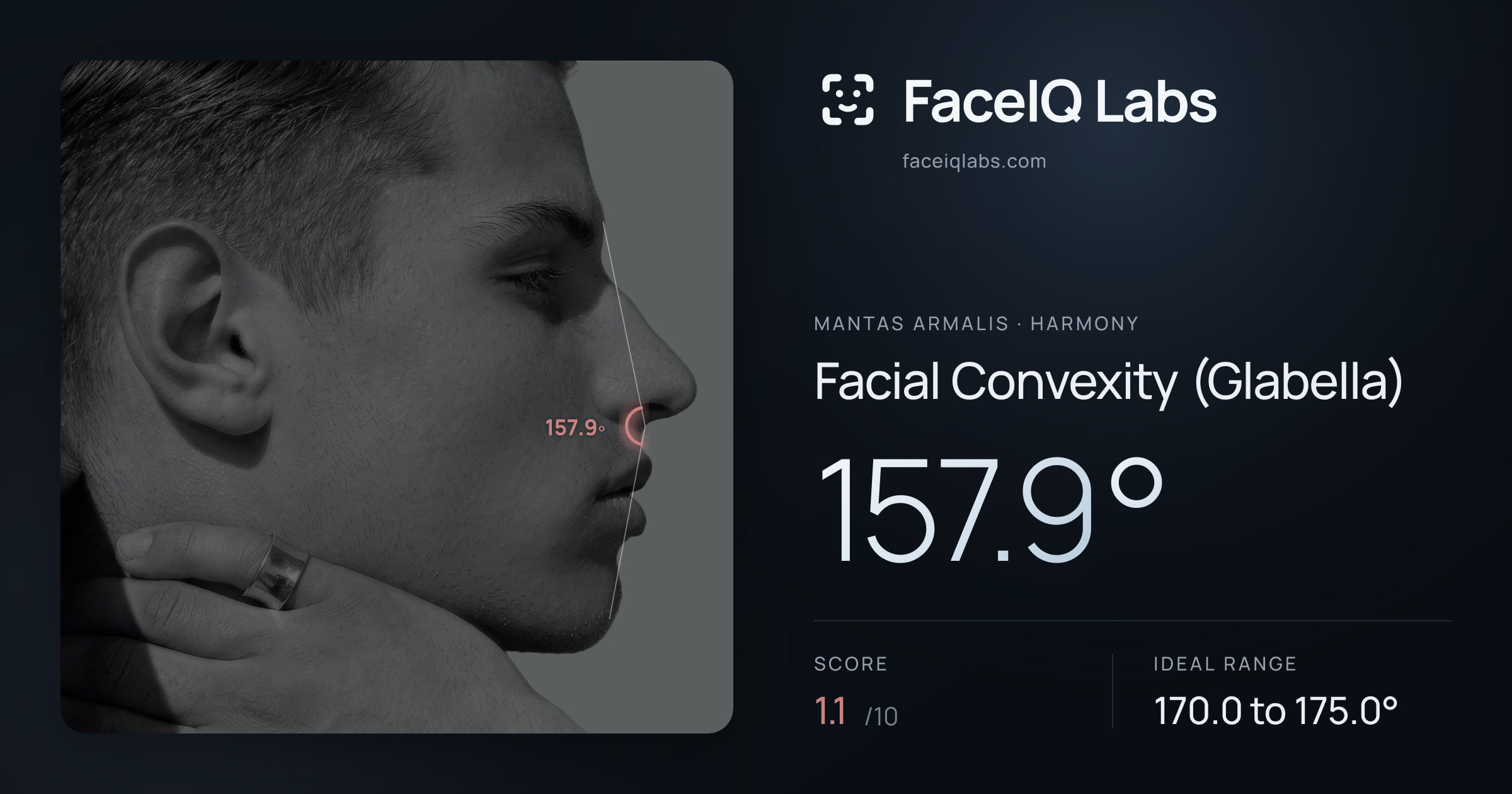 Mantas Armalis Facial Convexity (Glabella): 157.9°, drawn on the photo
