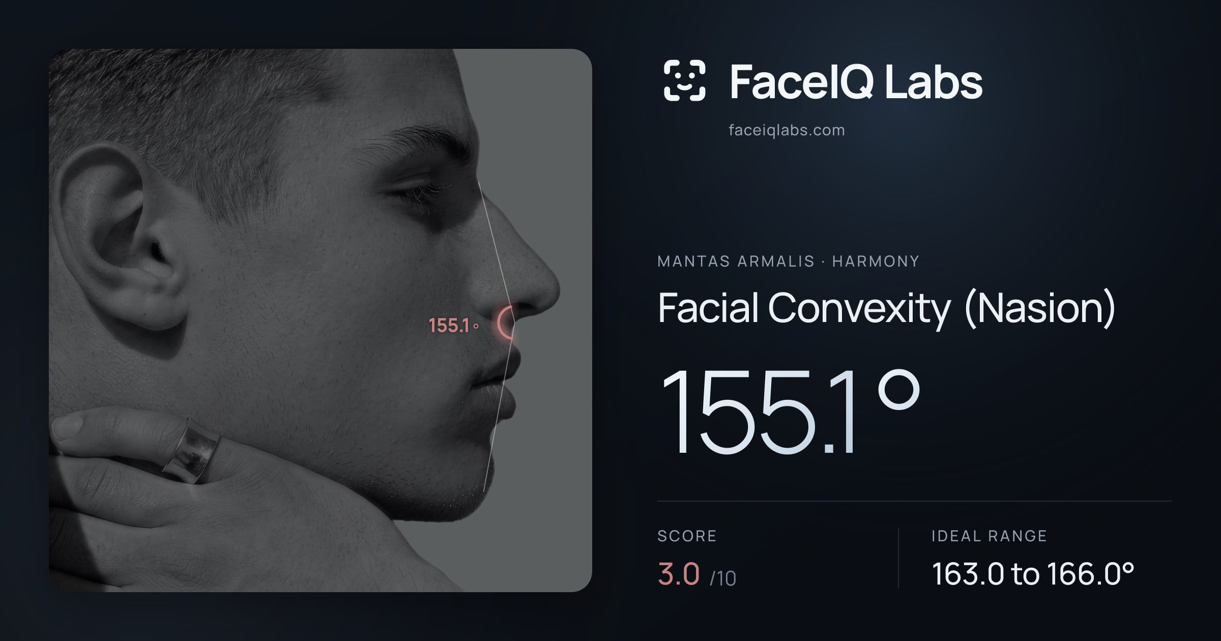 Mantas Armalis Facial Convexity (Nasion): 155.1°, drawn on the photo