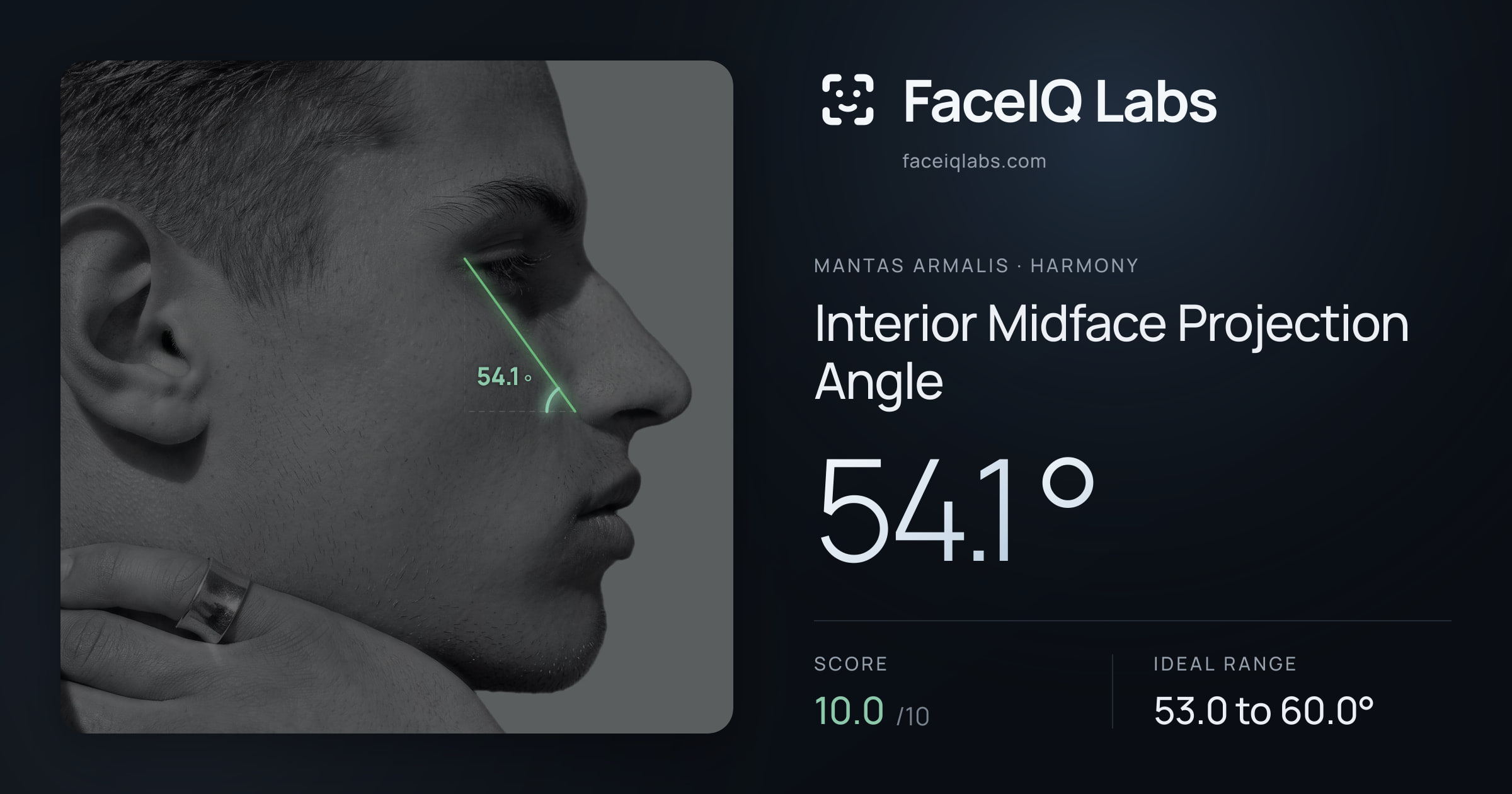 Mantas Armalis Interior Midface Projection Angle: 54.1°, drawn on the photo