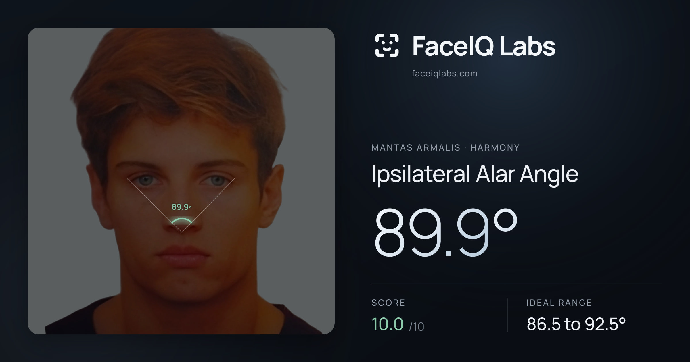 Mantas Armalis Ipsilateral Alar Angle: 89.9°, drawn on the photo