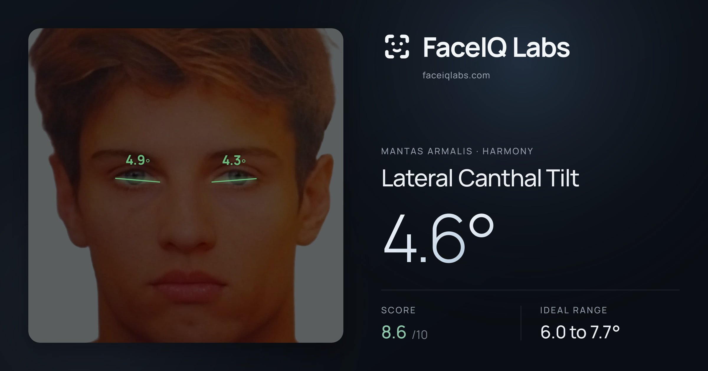 Mantas Armalis Lateral Canthal Tilt: 4.6°, drawn on the photo
