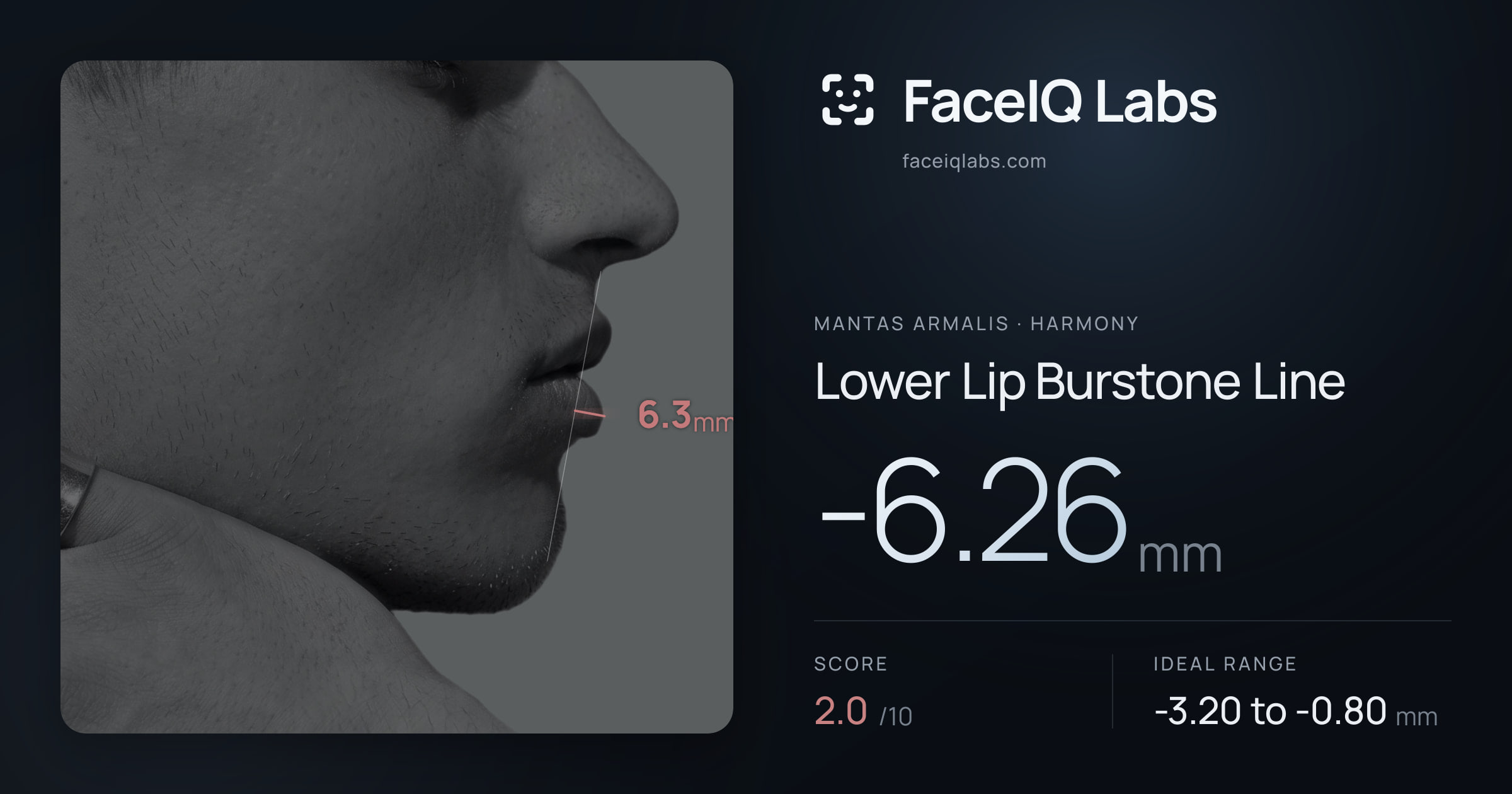 Mantas Armalis Lower Lip Burstone Line: -6.26mm, drawn on the photo
