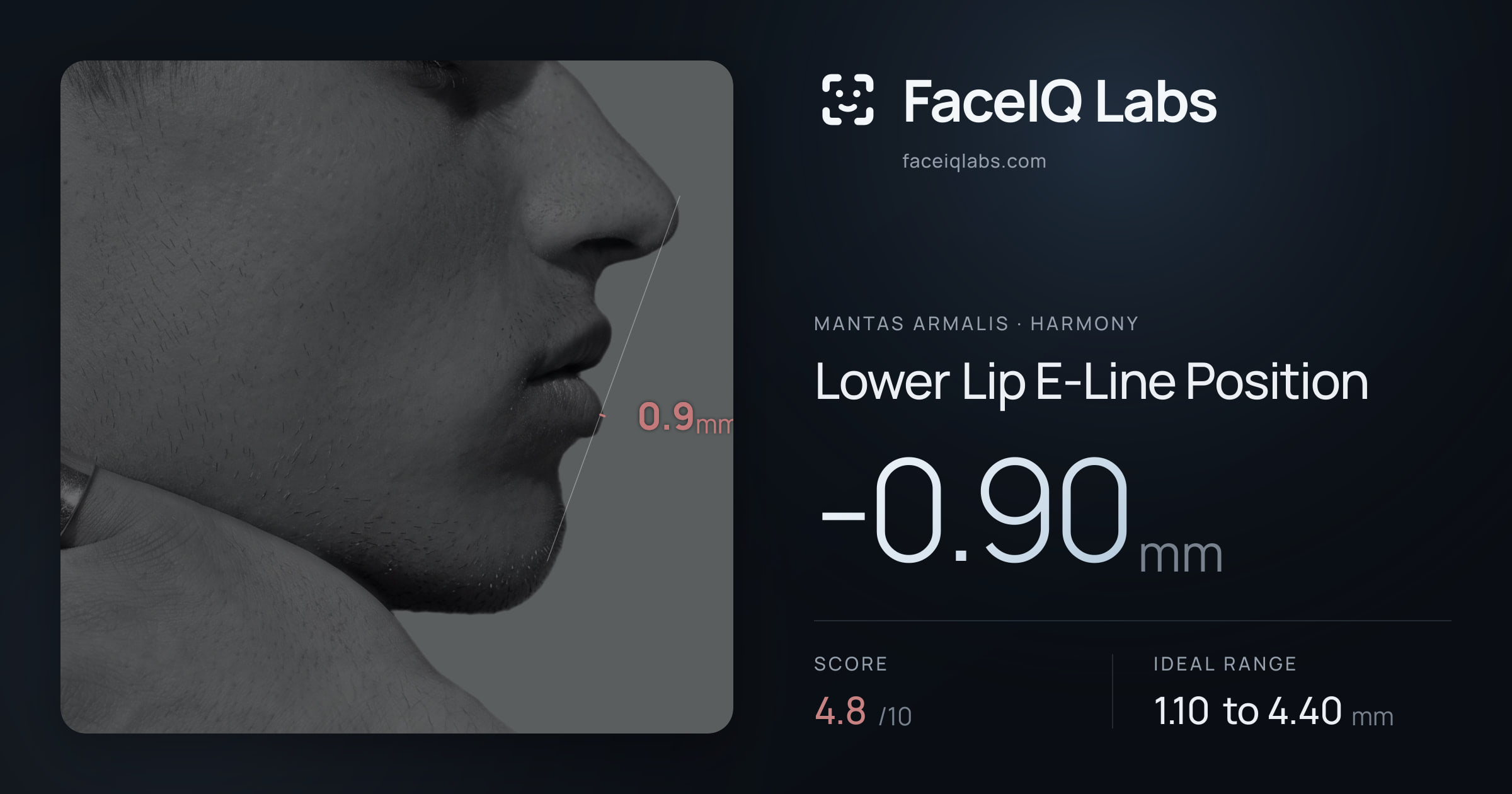 Mantas Armalis Lower Lip E-Line Position: -0.90mm, drawn on the photo
