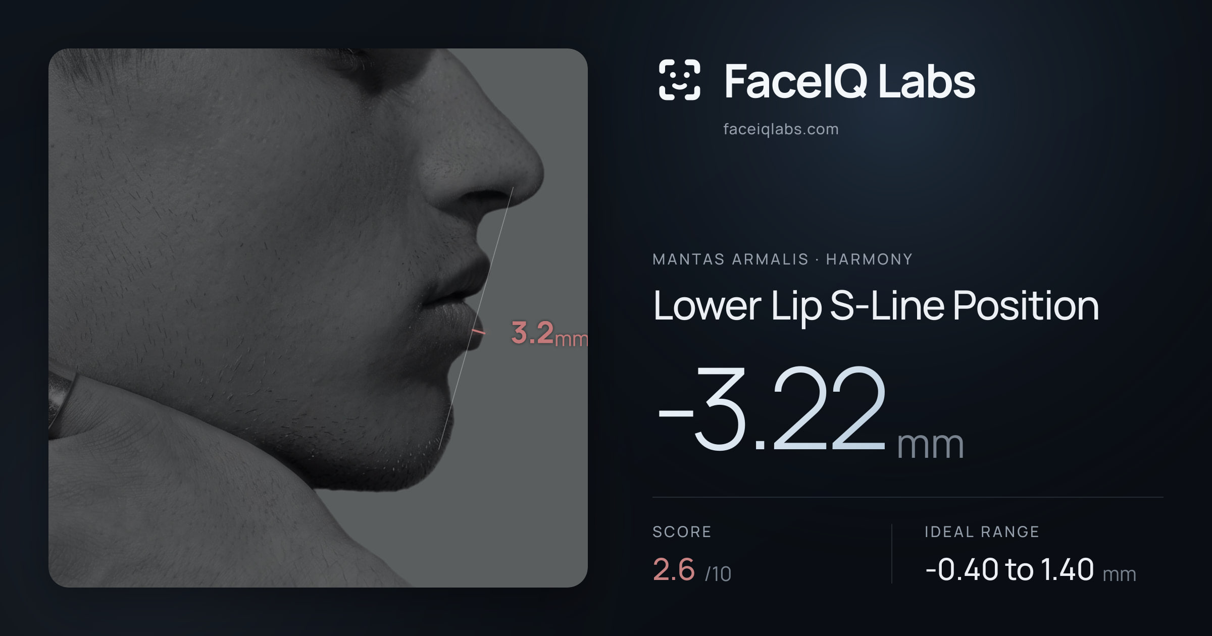 Mantas Armalis Lower Lip S-Line Position: -3.22mm, drawn on the photo