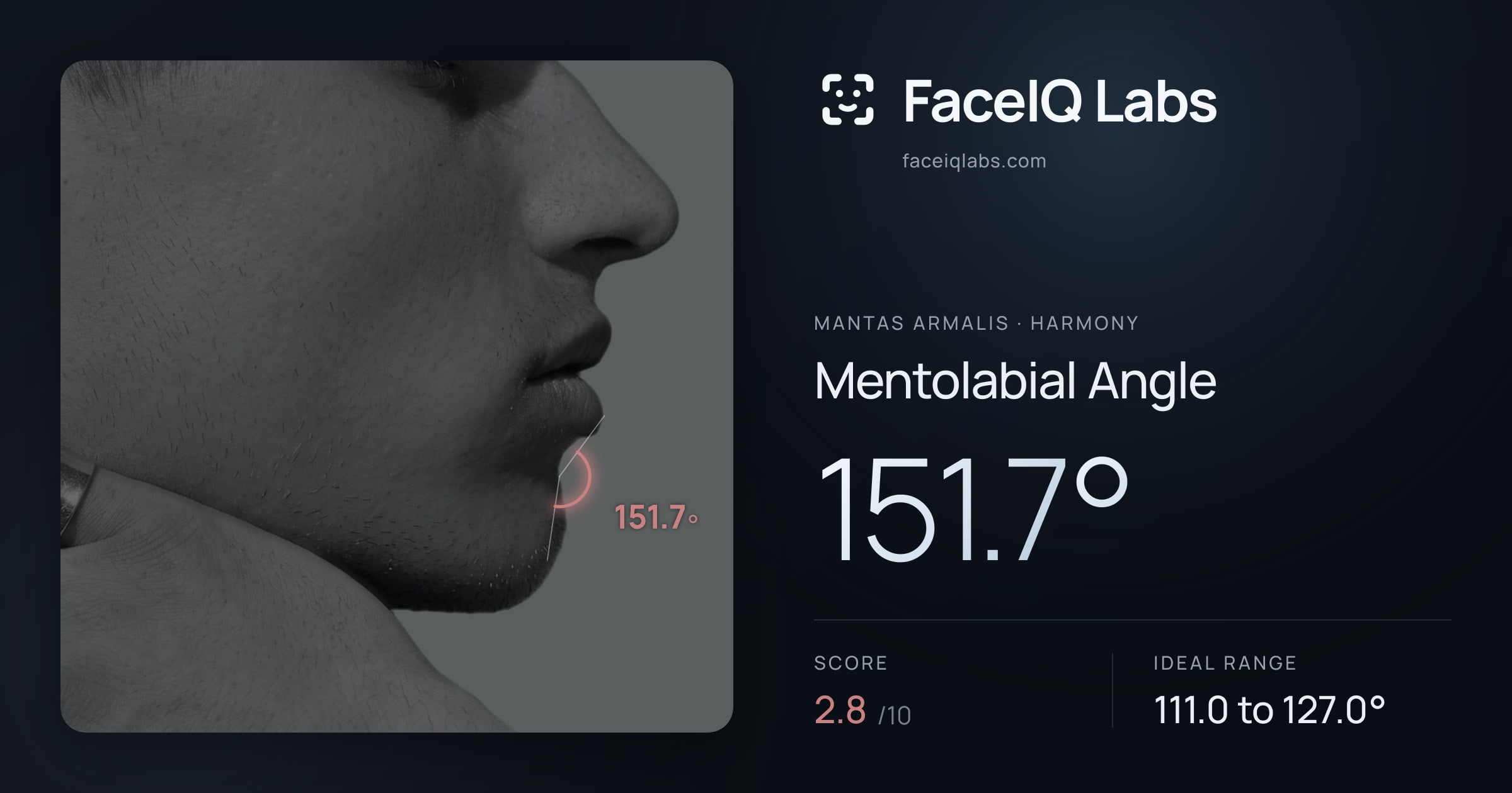 Mantas Armalis Mentolabial Angle: 151.7°, drawn on the photo
