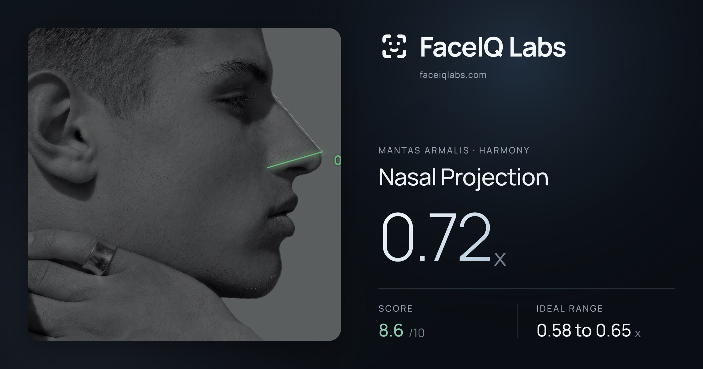 Mantas Armalis Nasal Projection: 0.72x, drawn on the photo