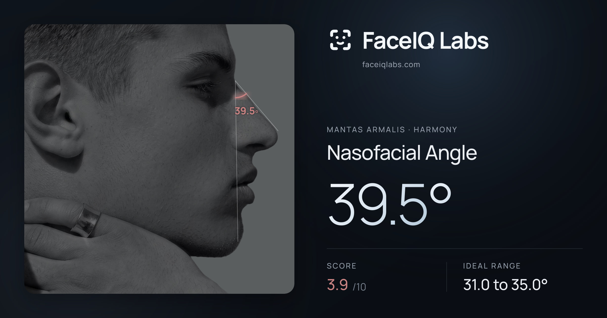 Mantas Armalis Nasofacial Angle: 39.5°, drawn on the photo