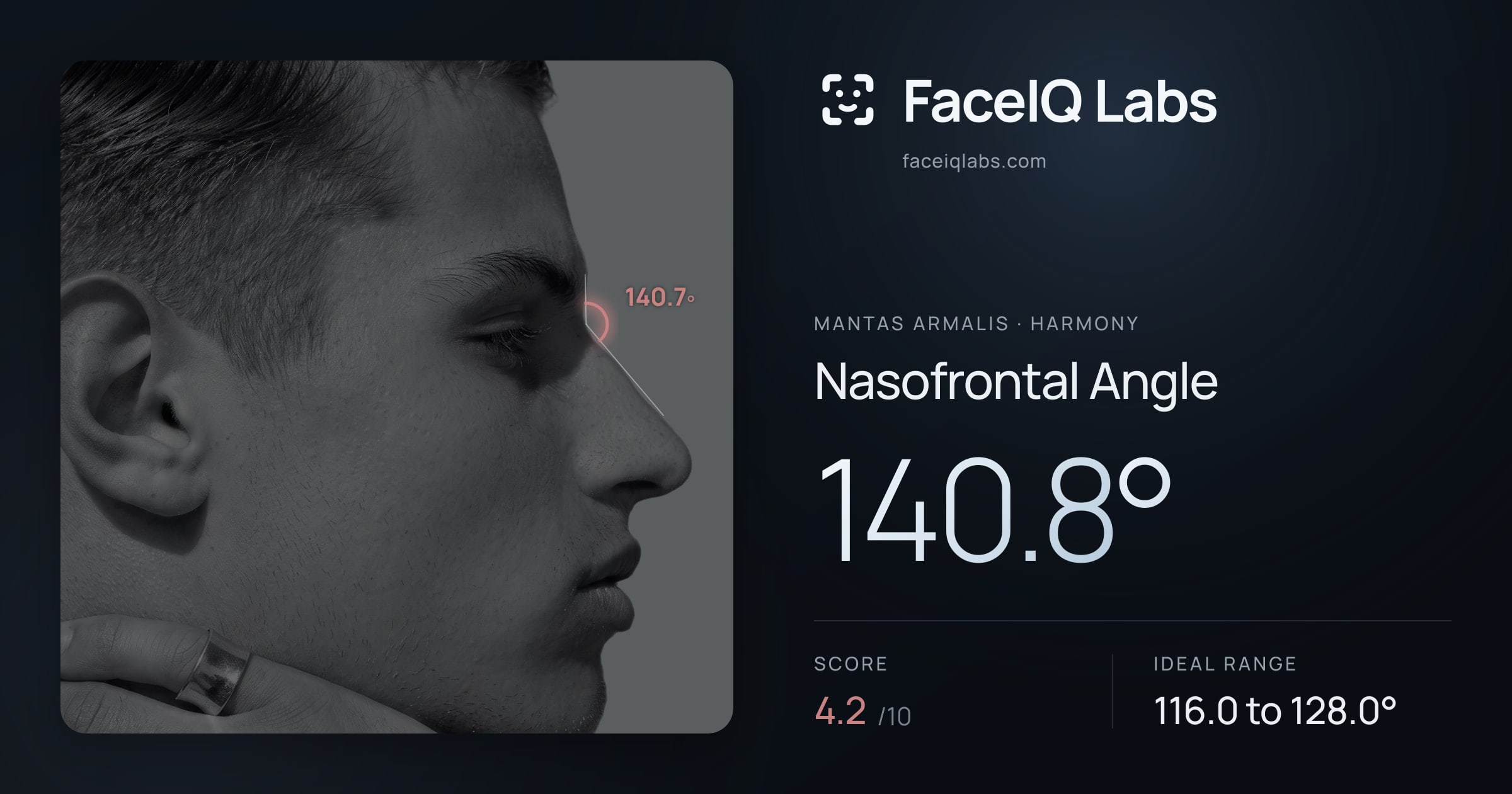 Mantas Armalis Nasofrontal Angle: 140.8°, drawn on the photo