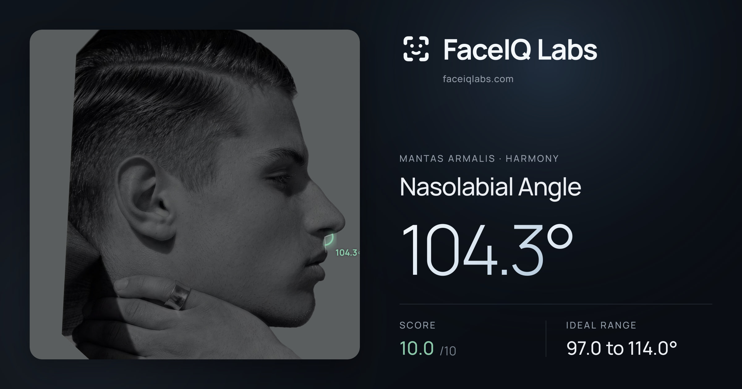 Mantas Armalis Nasolabial Angle: 104.3°, drawn on the photo