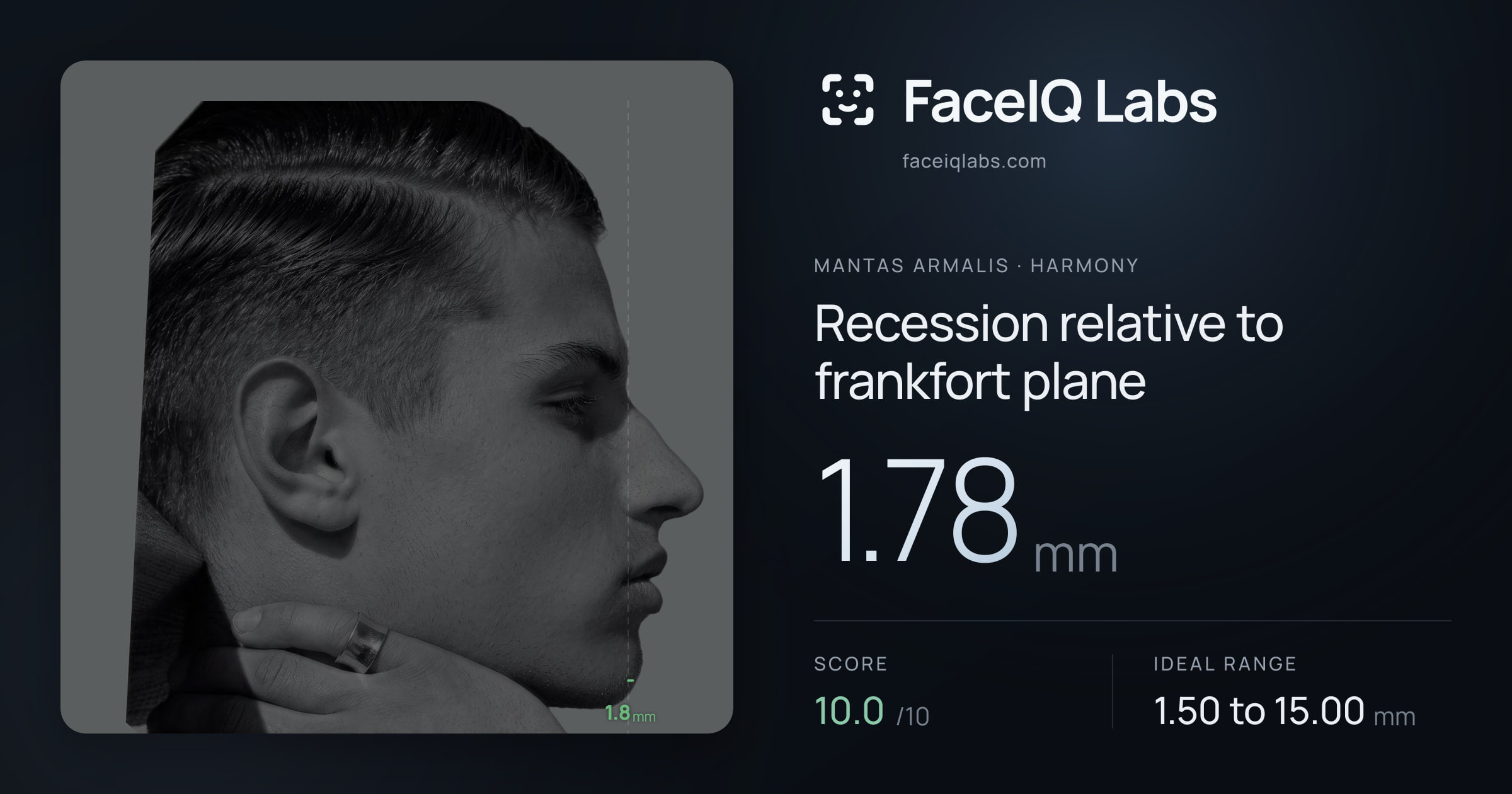 Mantas Armalis Recession relative to frankfort plane: 1.78mm, drawn on the photo