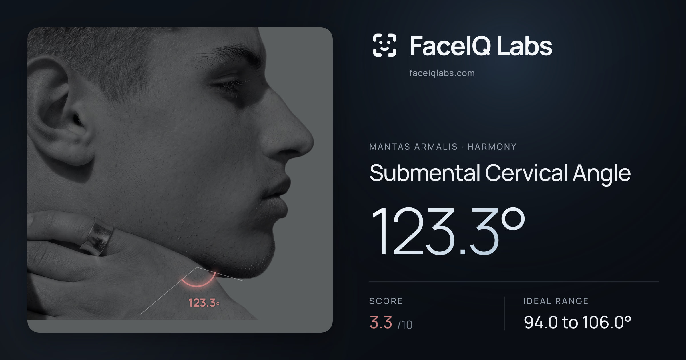 Mantas Armalis Submental Cervical Angle: 123.3°, drawn on the photo
