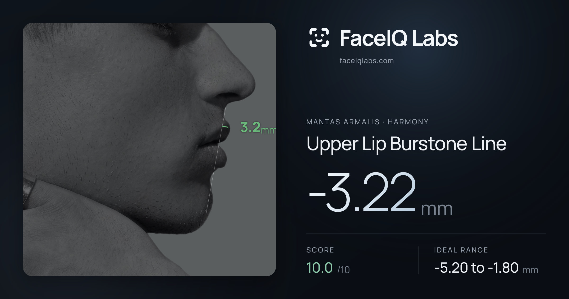 Mantas Armalis Upper Lip Burstone Line: -3.22mm, drawn on the photo