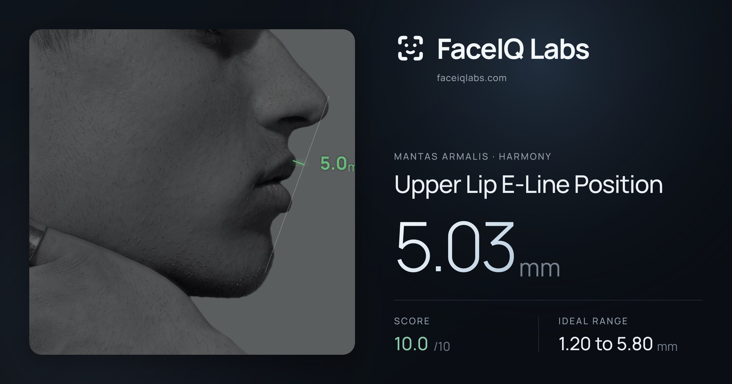 Mantas Armalis Upper Lip E-Line Position: 5.03mm, drawn on the photo