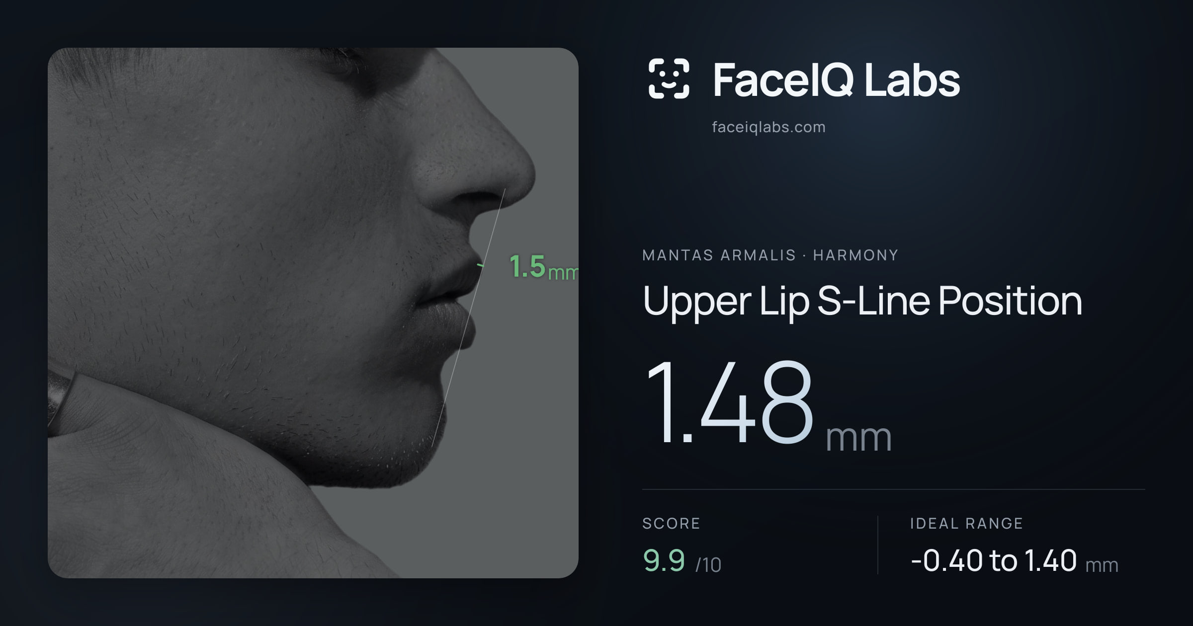 Mantas Armalis Upper Lip S-Line Position: 1.48mm, drawn on the photo