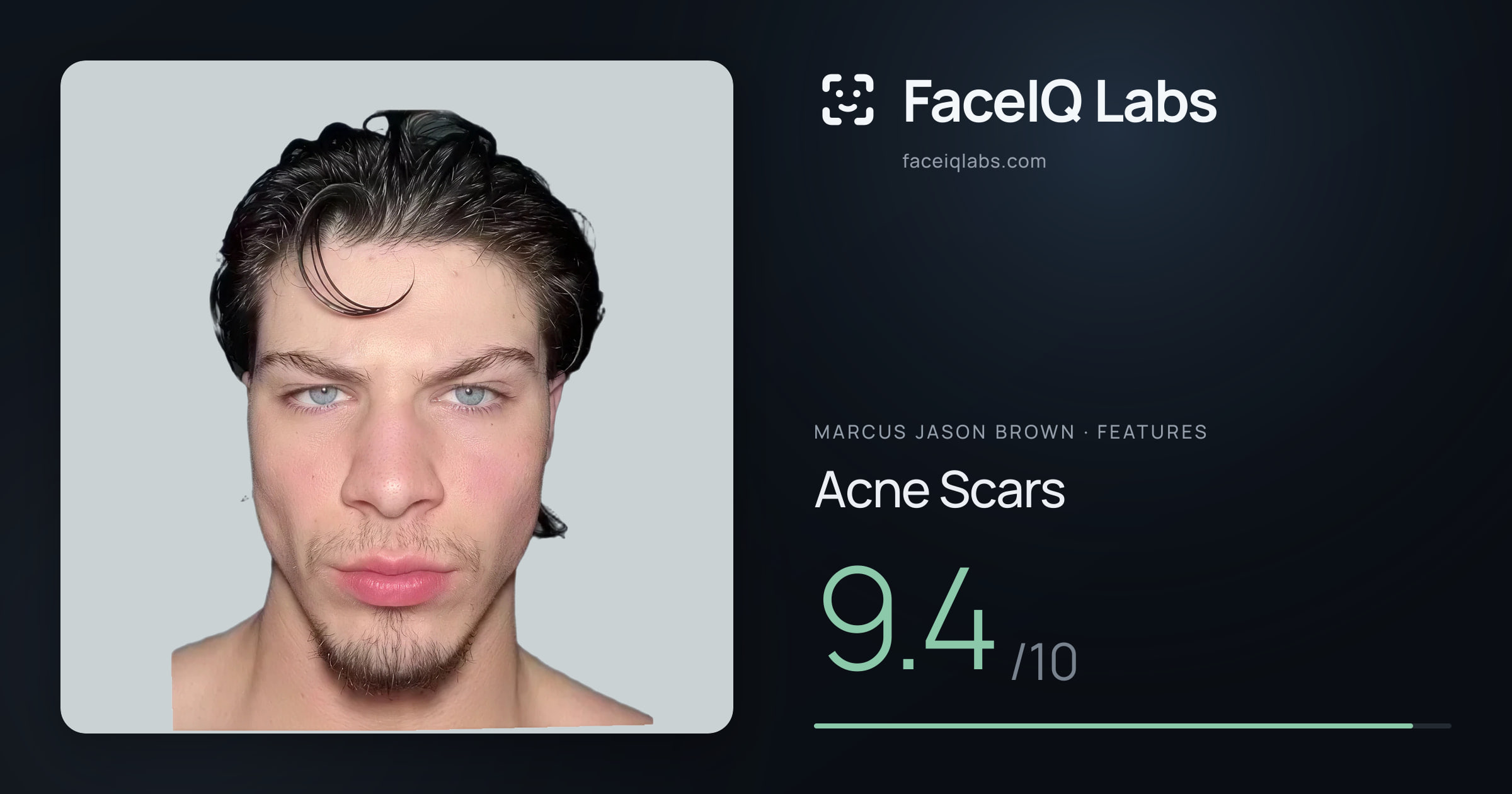 Marcus Jason Brown Acne Scars: 9.4/10, drawn on the photo
