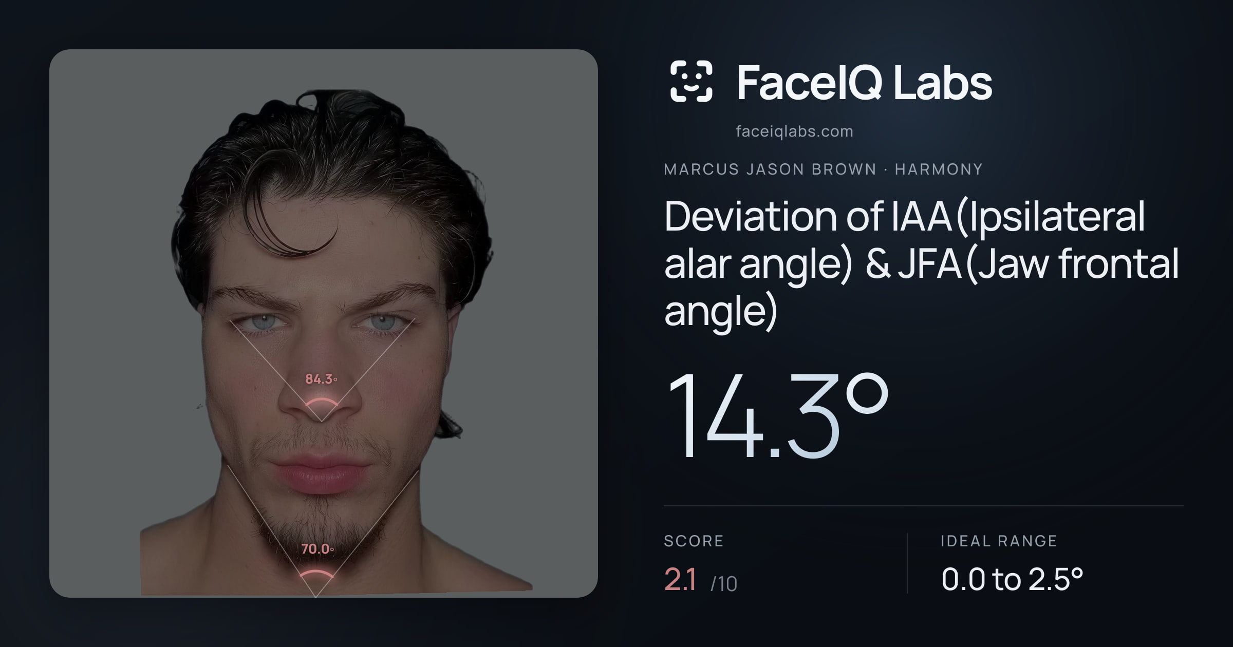 Marcus Jason Brown Deviation of IAA(Ipsilateral alar angle) & JFA(Jaw frontal angle): 14.3°, drawn on the photo