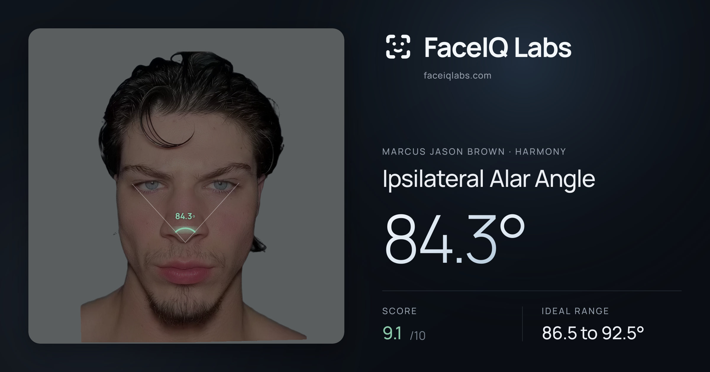 Marcus Jason Brown Ipsilateral Alar Angle: 84.3°, drawn on the photo
