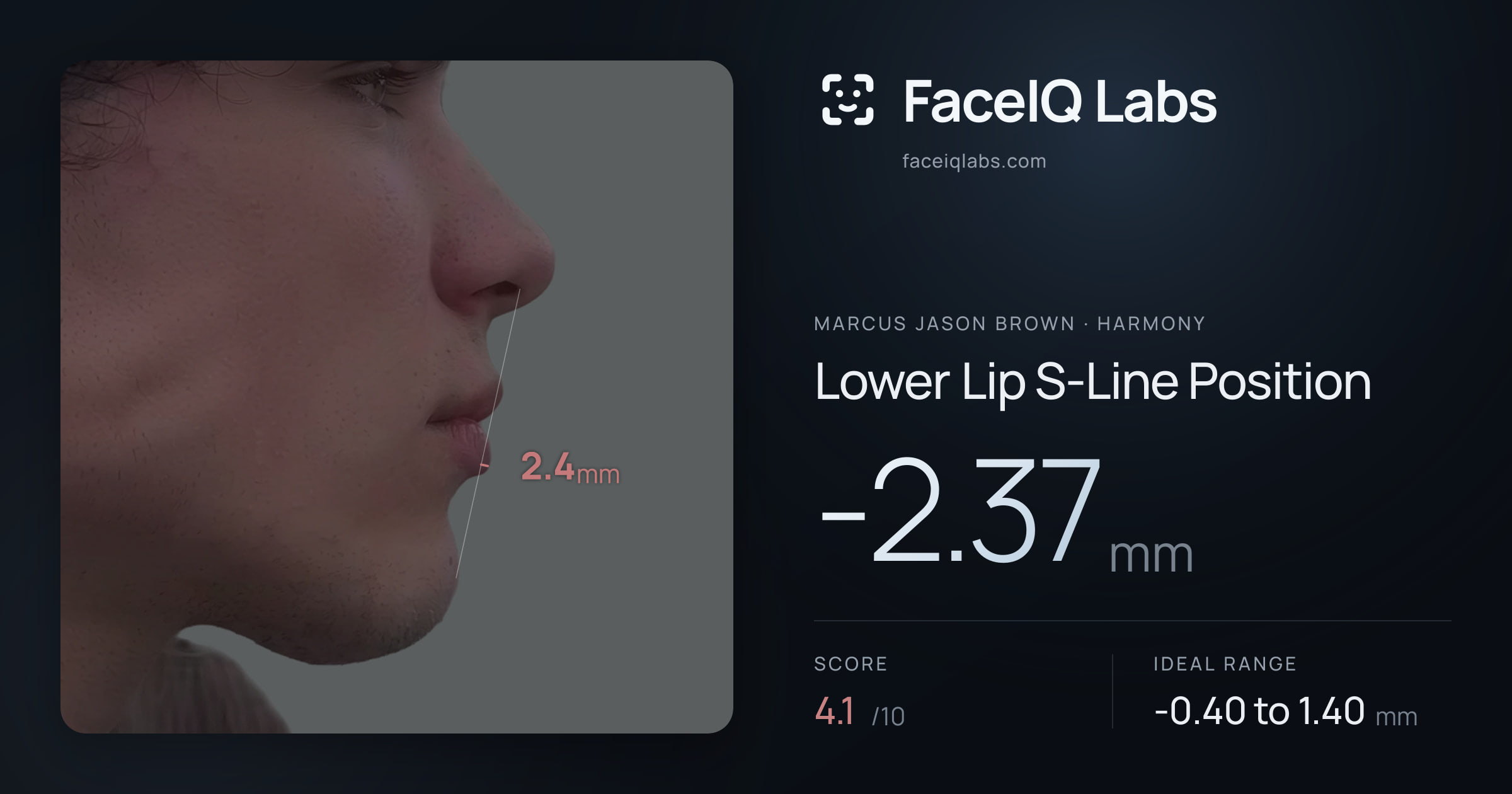 Marcus Jason Brown Lower Lip S-Line Position: -2.37mm, drawn on the photo
