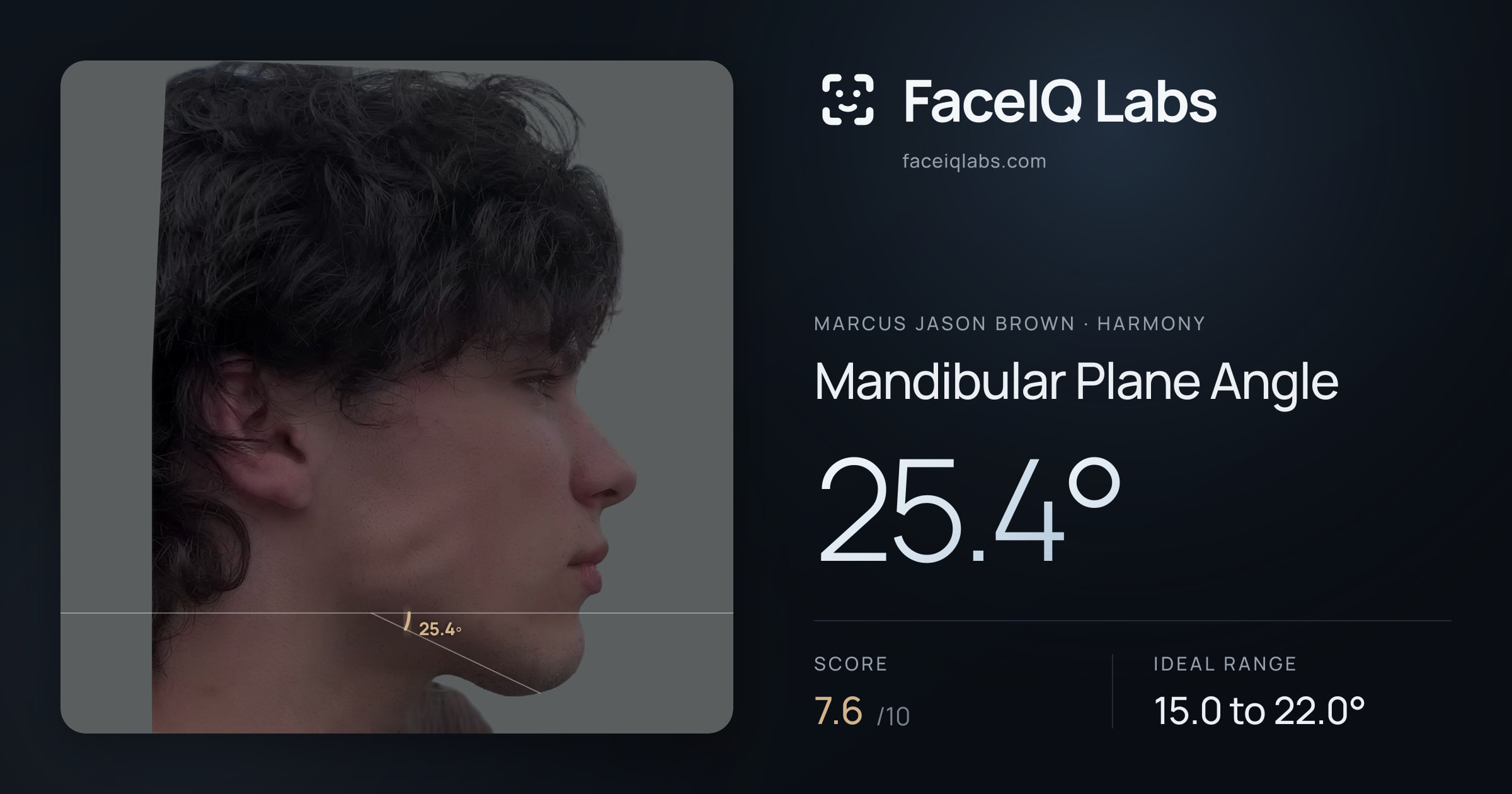 Marcus Jason Brown Mandibular Plane Angle: 25.4°, drawn on the photo