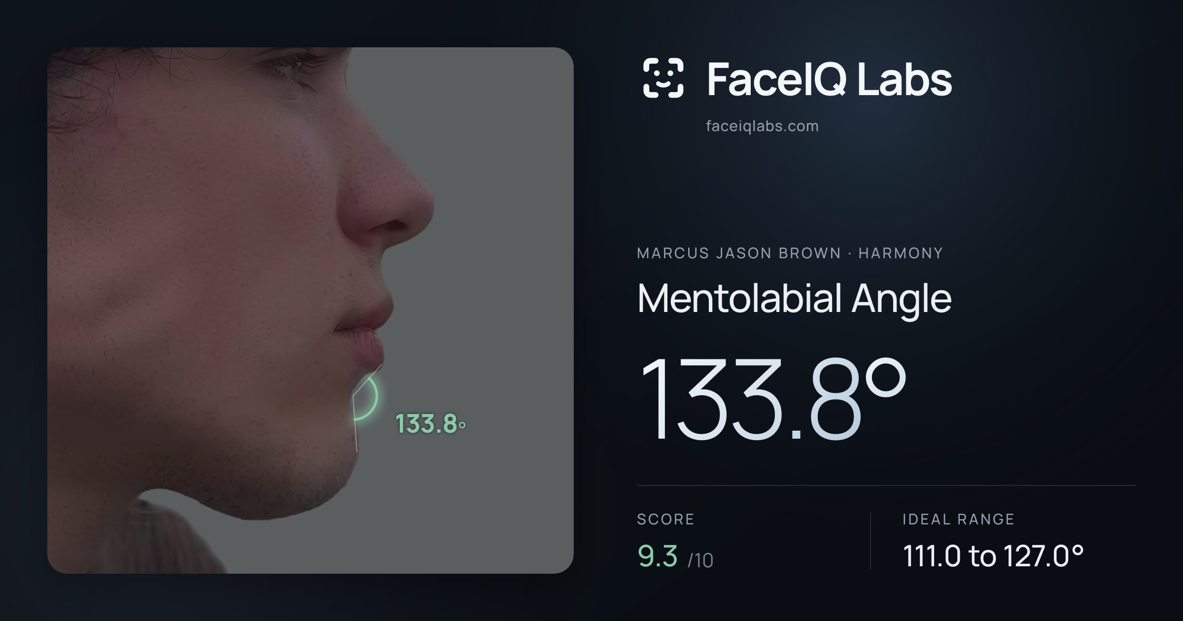 Marcus Jason Brown Mentolabial Angle: 133.8°, drawn on the photo