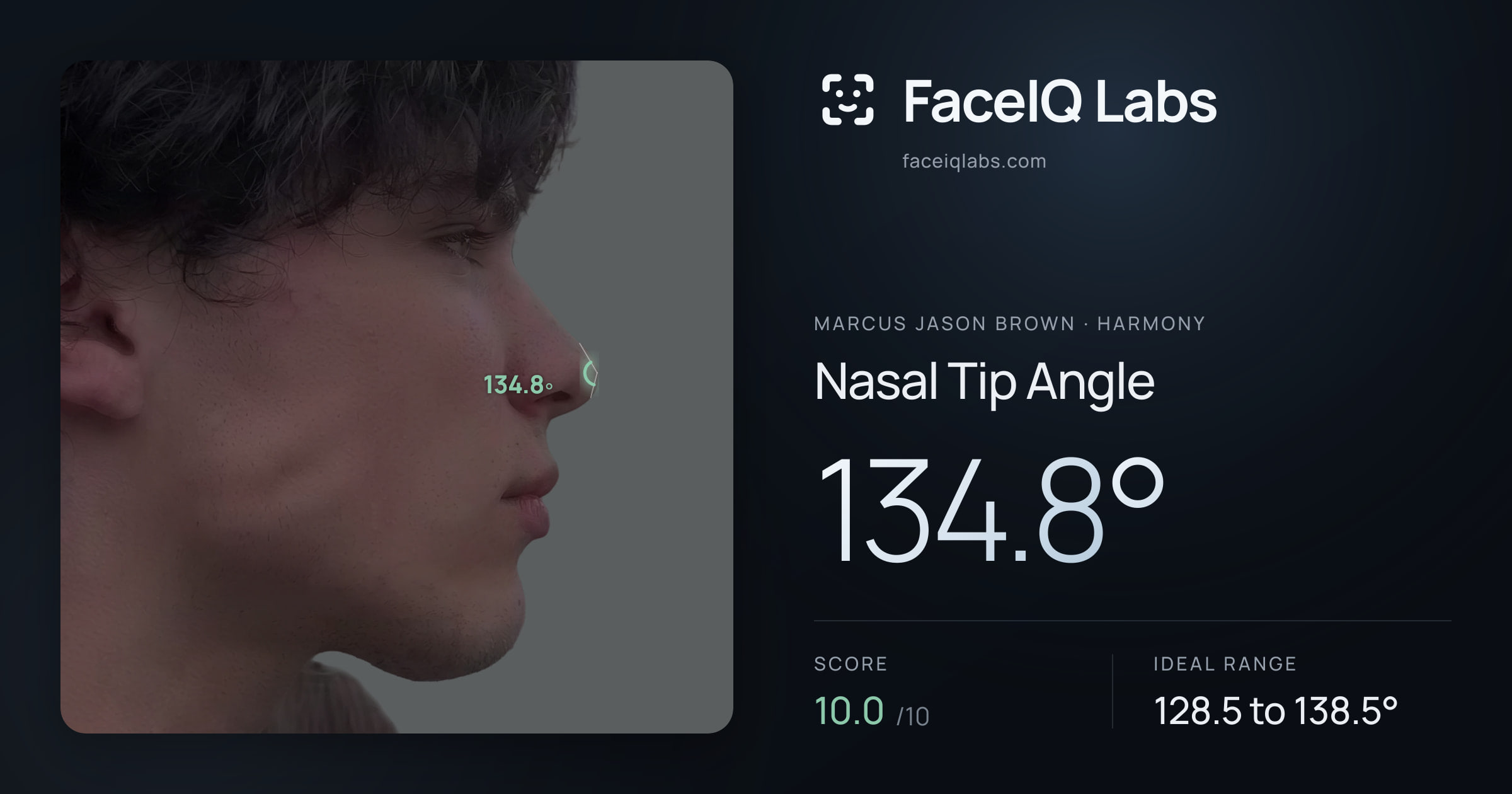 Marcus Jason Brown Nasal Tip Angle: 134.8°, drawn on the photo