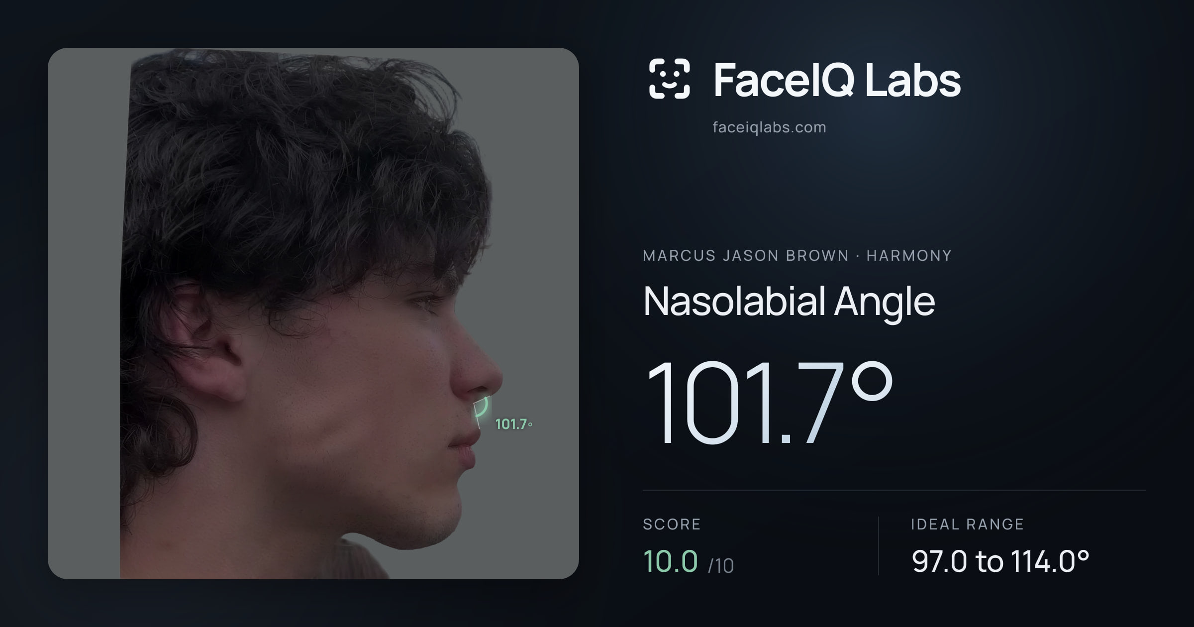 Marcus Jason Brown Nasolabial Angle: 101.7°, drawn on the photo