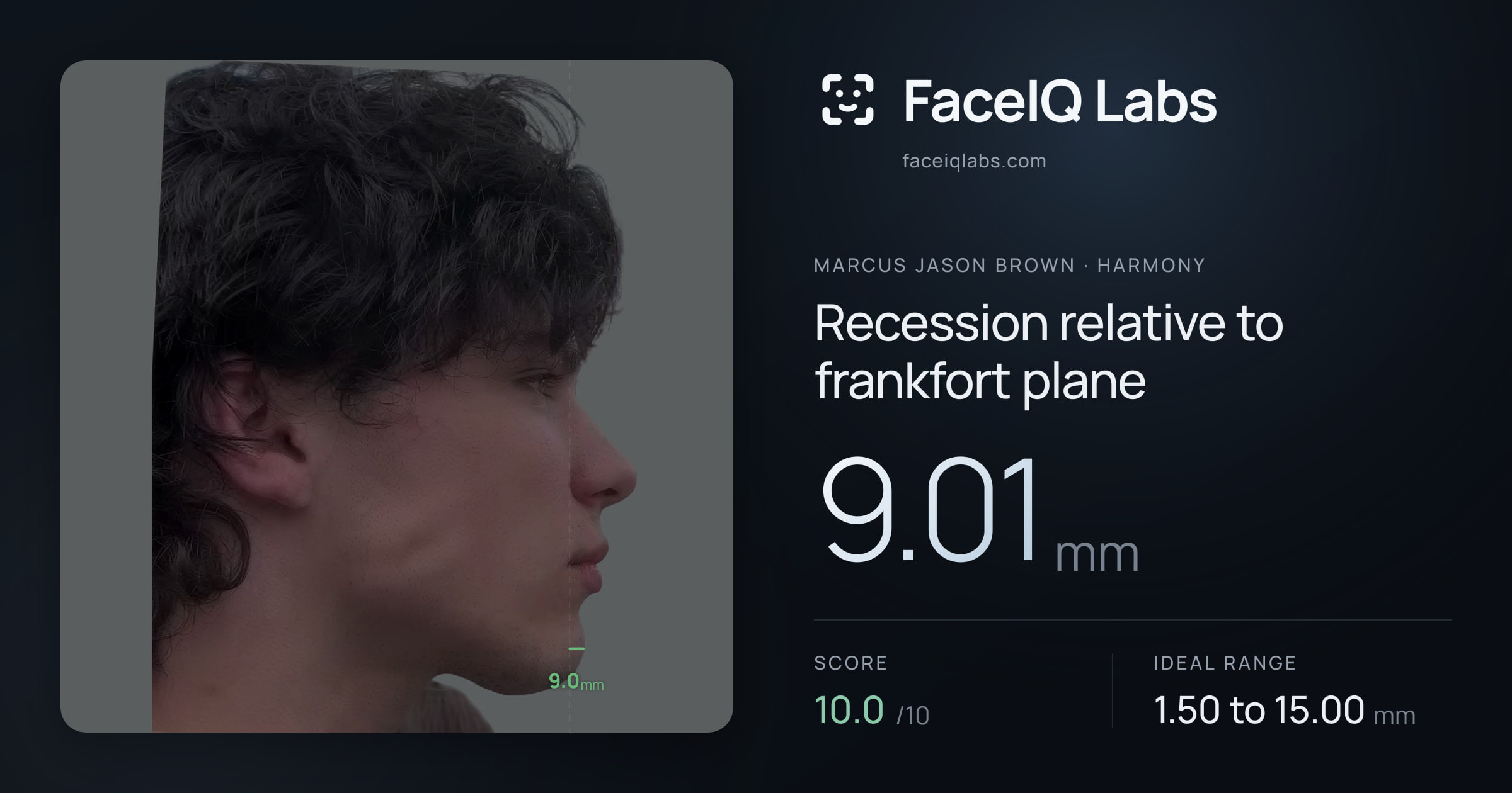 Marcus Jason Brown Recession relative to frankfort plane: 9.01mm, drawn on the photo