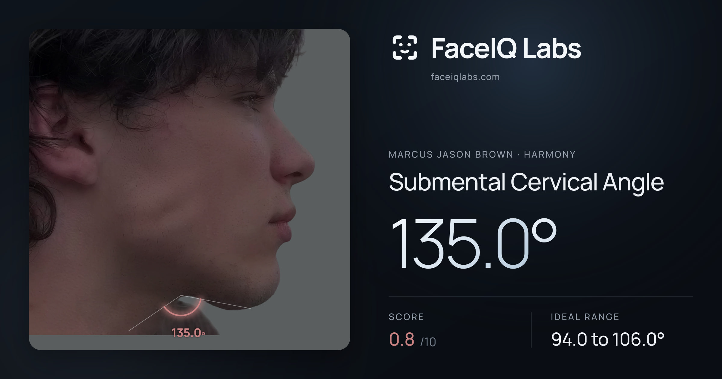 Marcus Jason Brown Submental Cervical Angle: 135.0°, drawn on the photo