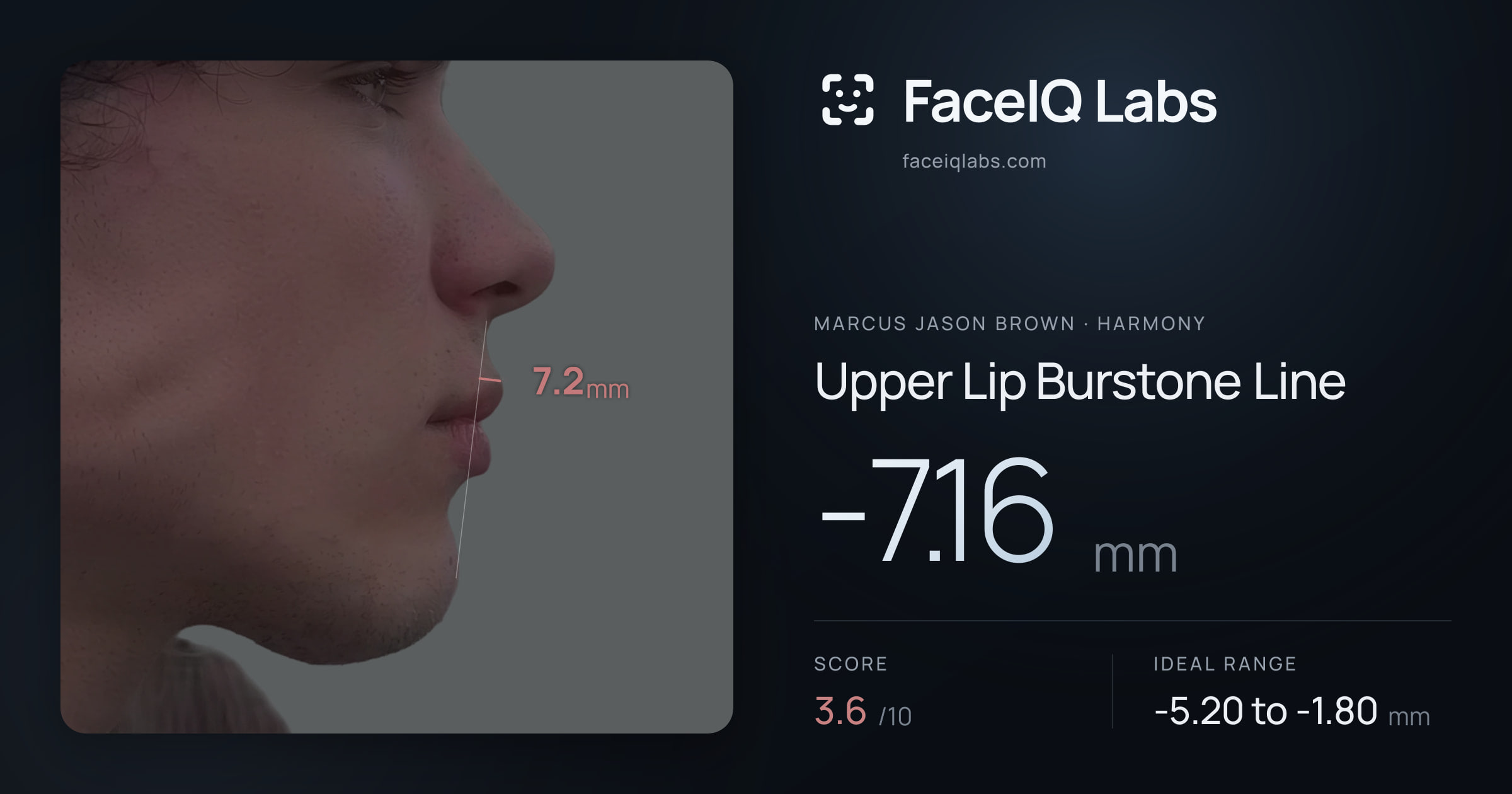 Marcus Jason Brown Upper Lip Burstone Line: -7.16mm, drawn on the photo