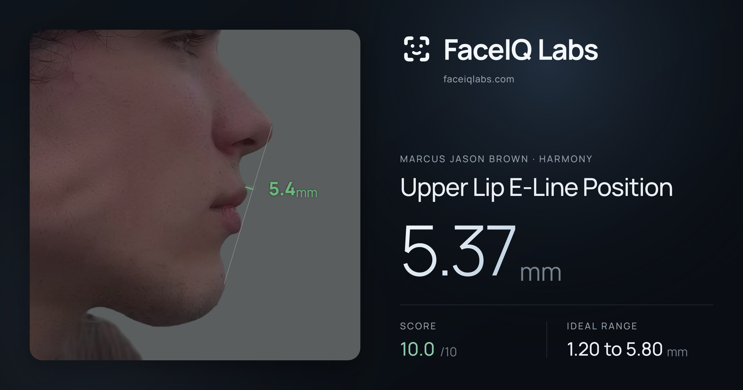 Marcus Jason Brown Upper Lip E-Line Position: 5.37mm, drawn on the photo