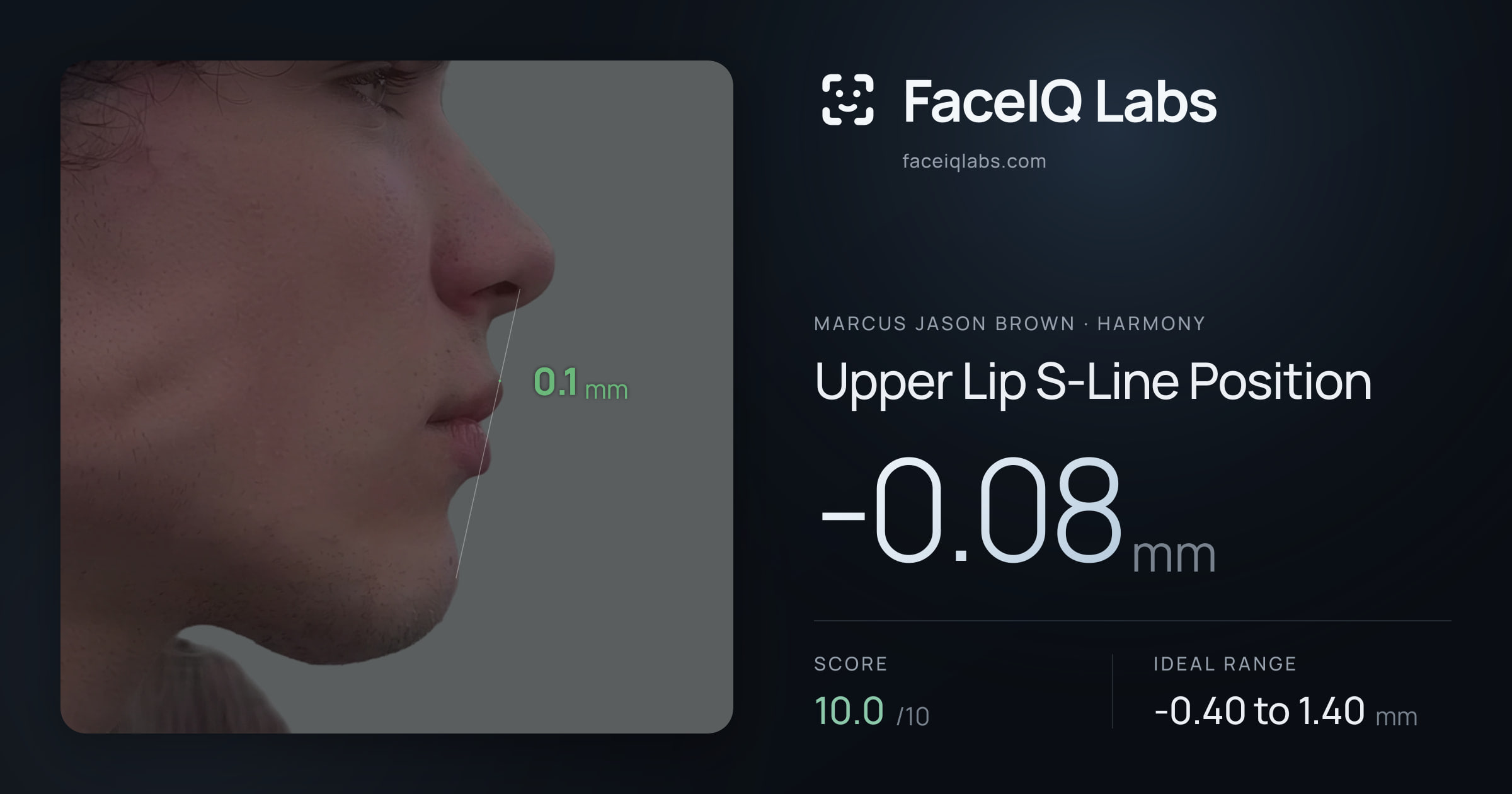 Marcus Jason Brown Upper Lip S-Line Position: -0.08mm, drawn on the photo