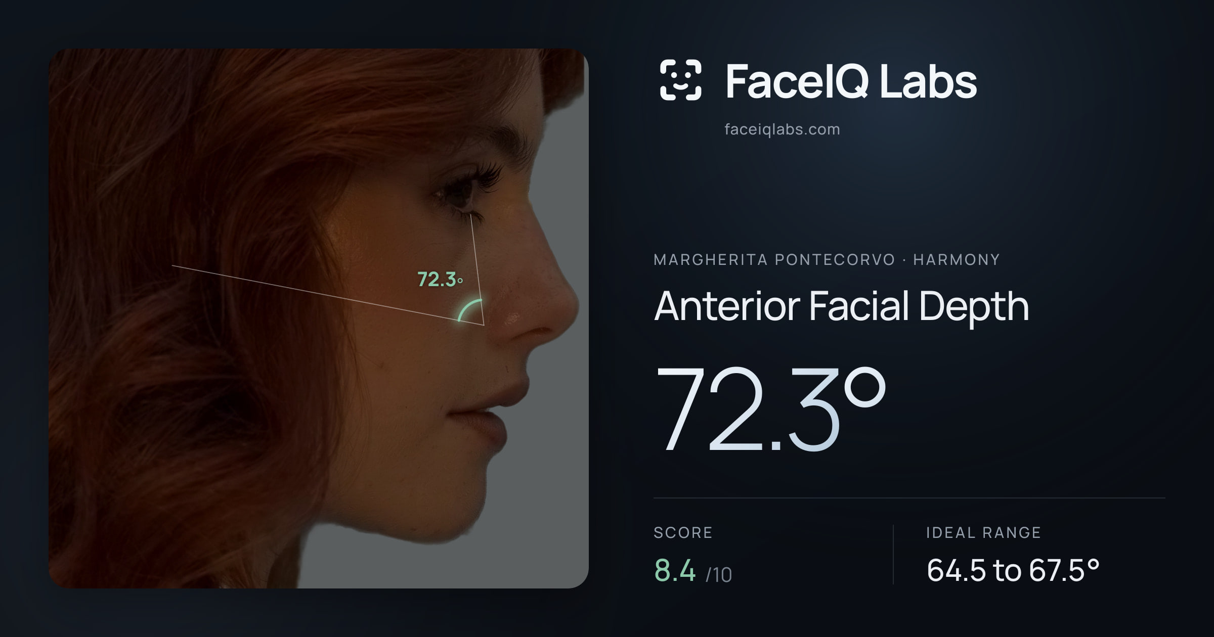 Margherita Pontecorvo Anterior Facial Depth: 72.3°, drawn on the photo