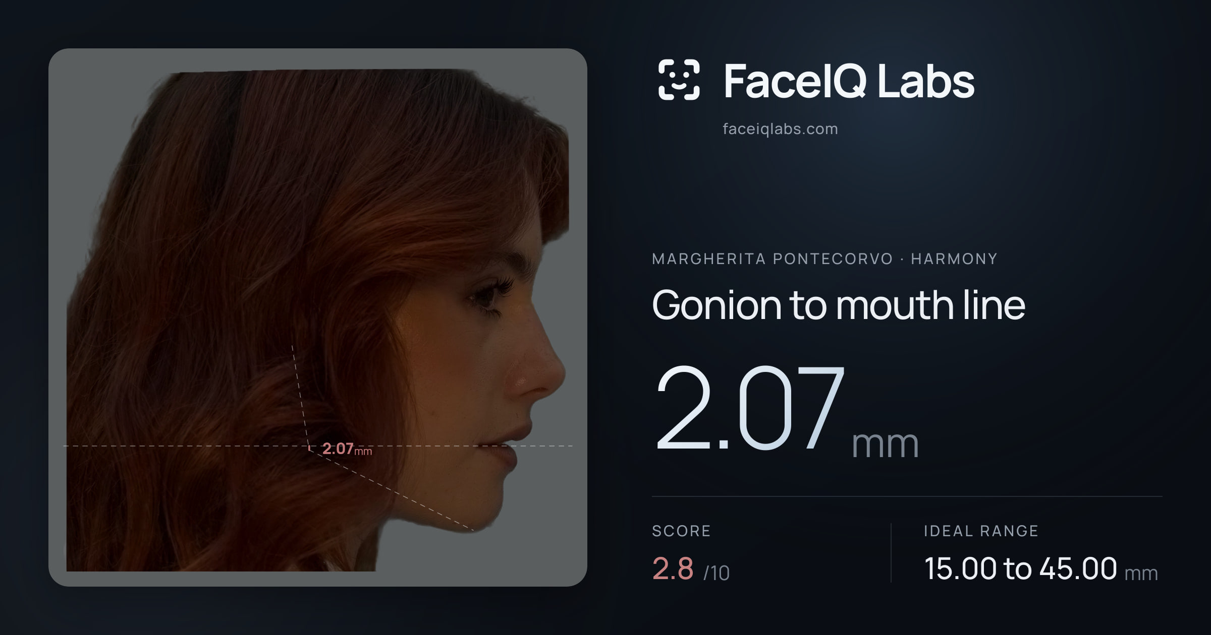 Margherita Pontecorvo Gonion to mouth line: 2.07mm, drawn on the photo