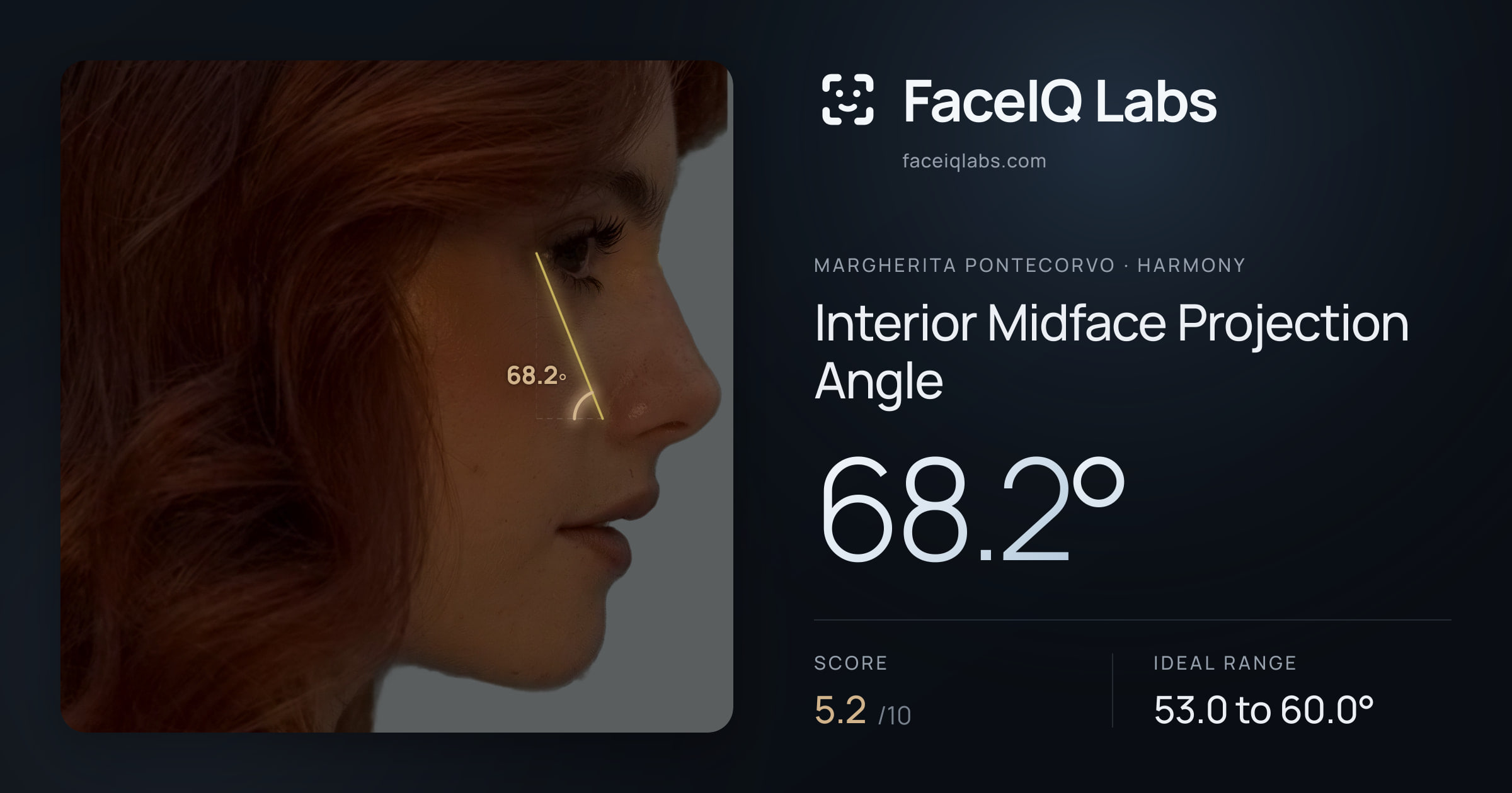 Margherita Pontecorvo Interior Midface Projection Angle: 68.2°, drawn on the photo