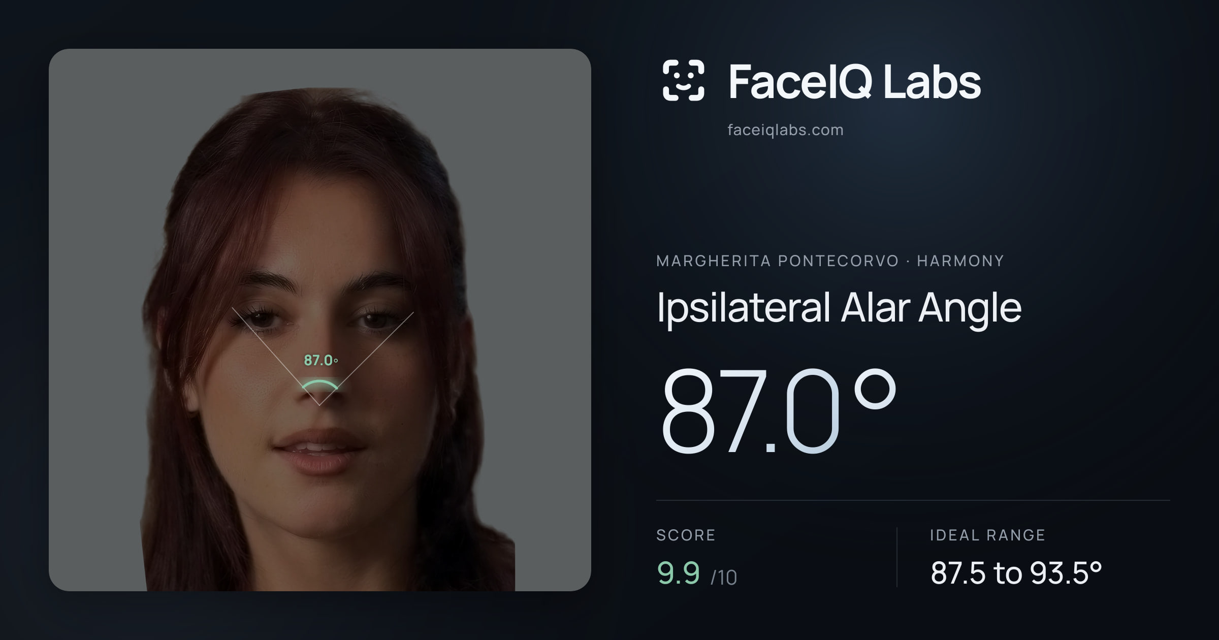 Margherita Pontecorvo Ipsilateral Alar Angle: 87.0°, drawn on the photo