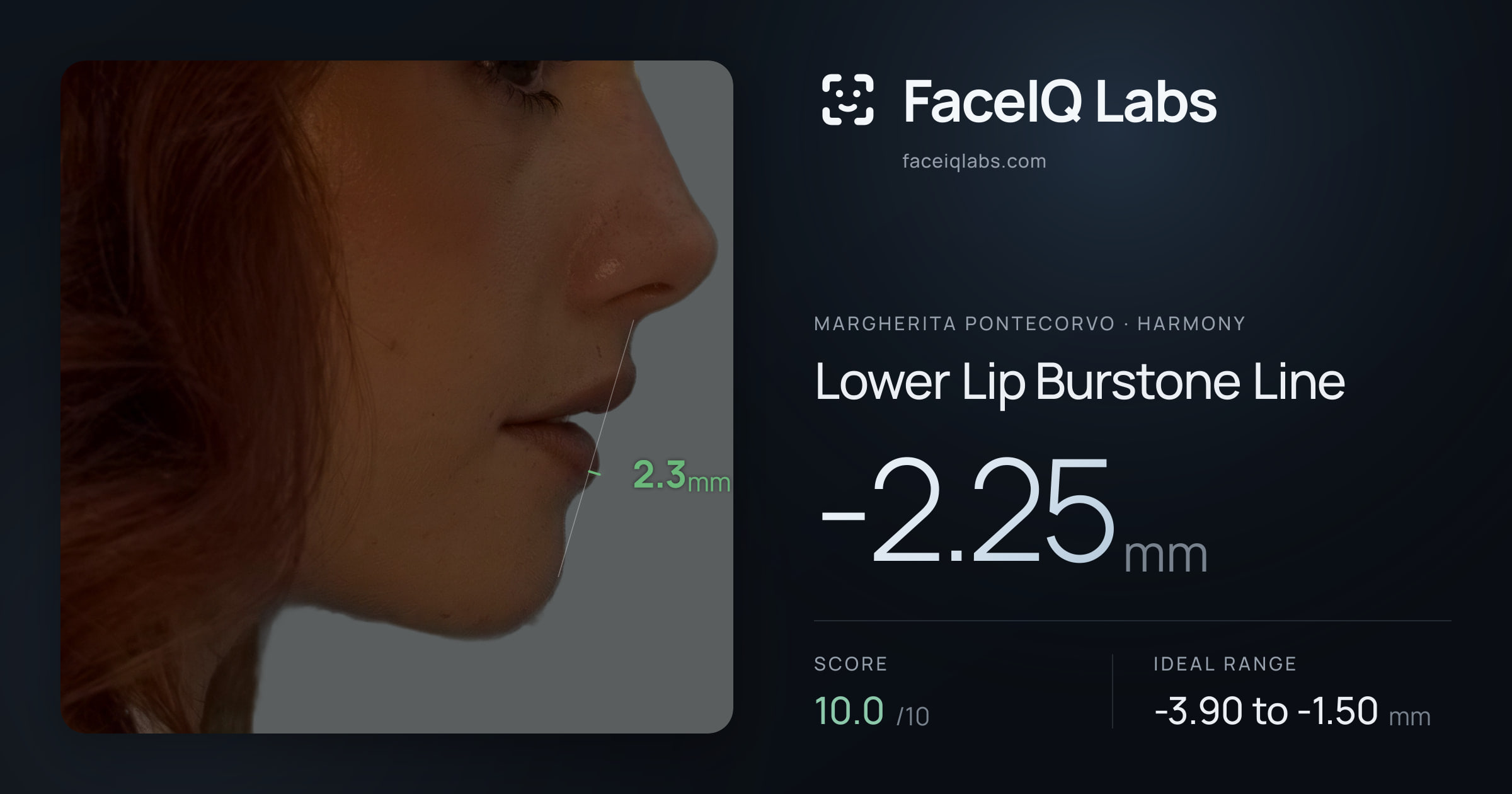 Margherita Pontecorvo Lower Lip Burstone Line: -2.25mm, drawn on the photo