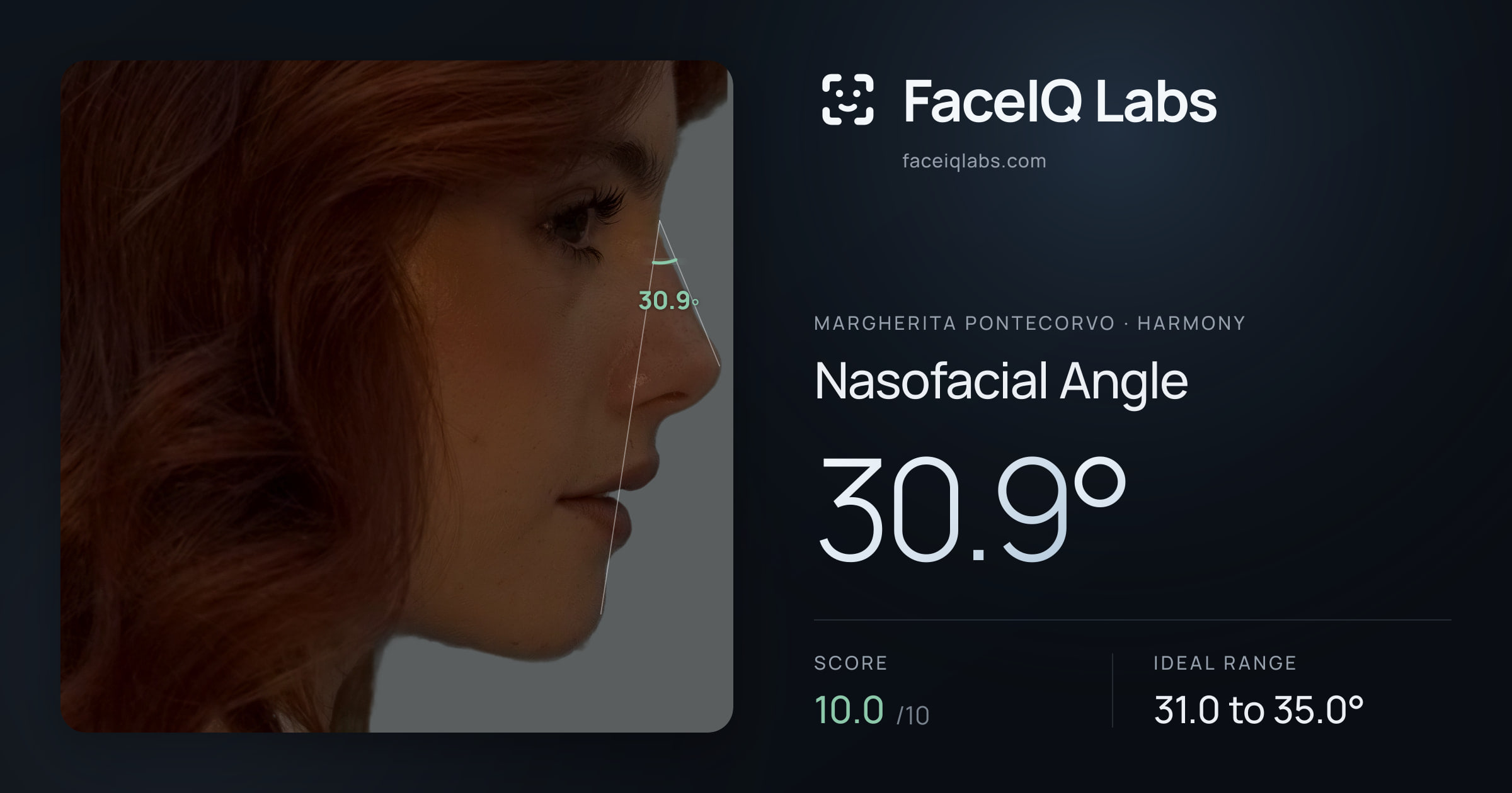 Margherita Pontecorvo Nasofacial Angle: 30.9°, drawn on the photo