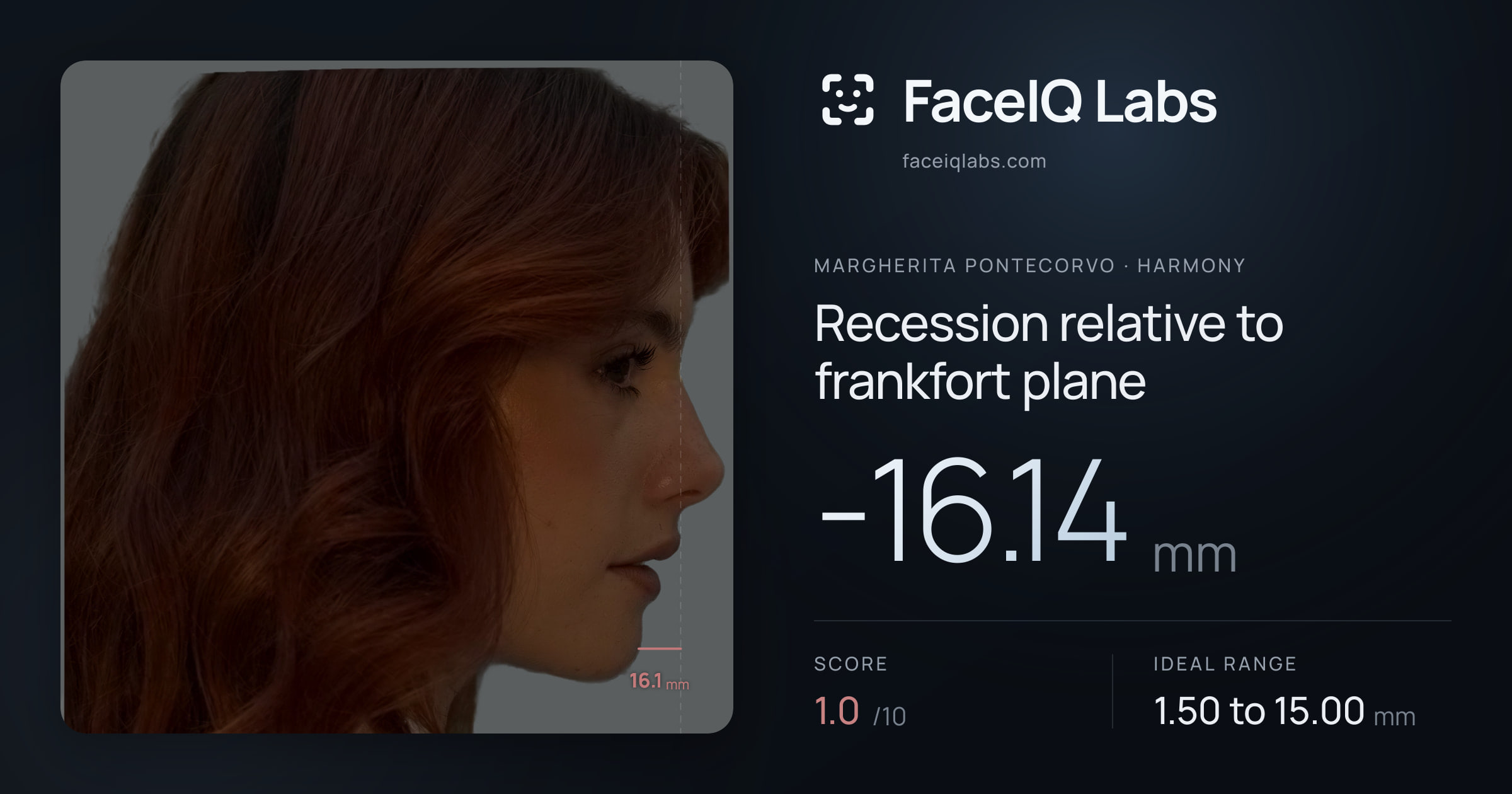 Margherita Pontecorvo Recession relative to frankfort plane: -16.14mm, drawn on the photo