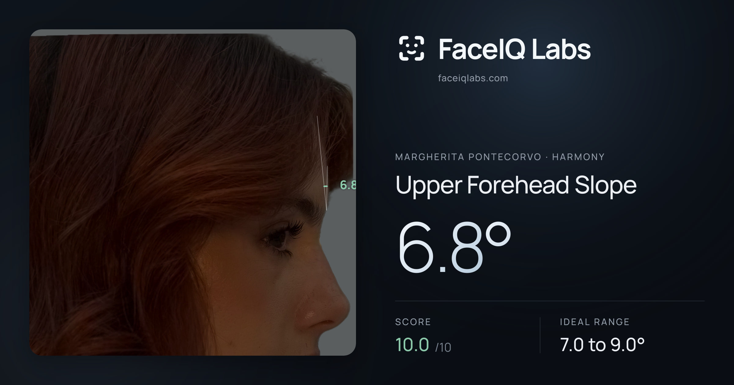 Margherita Pontecorvo Upper Forehead Slope: 6.8°, drawn on the photo