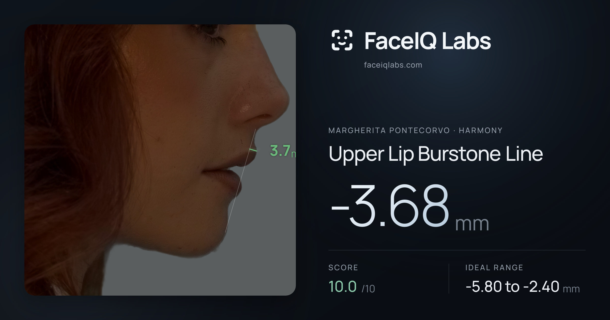 Margherita Pontecorvo Upper Lip Burstone Line: -3.68mm, drawn on the photo
