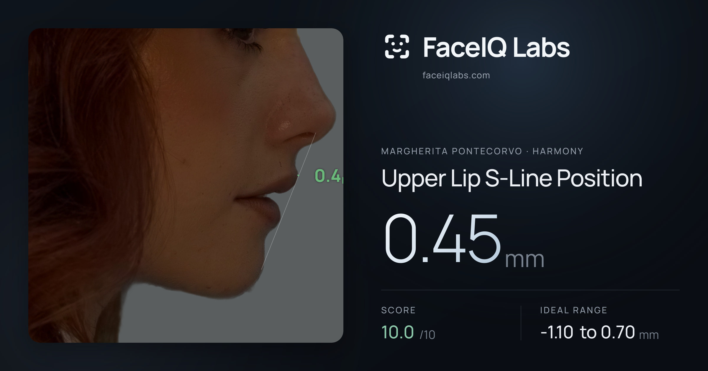 Margherita Pontecorvo Upper Lip S-Line Position: 0.45mm, drawn on the photo