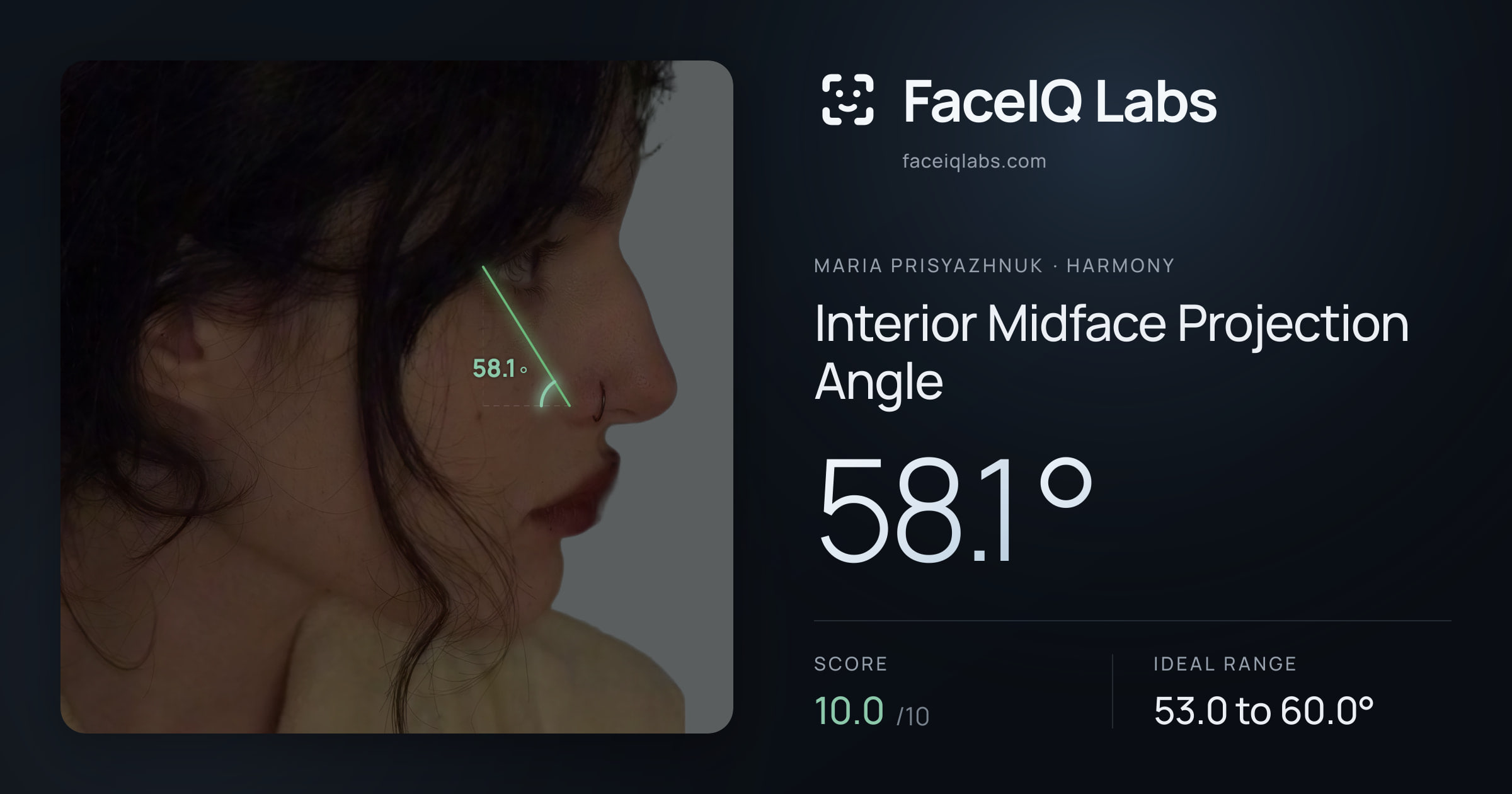 Maria Prisyazhnuk Interior Midface Projection Angle: 58.1°, drawn on the photo