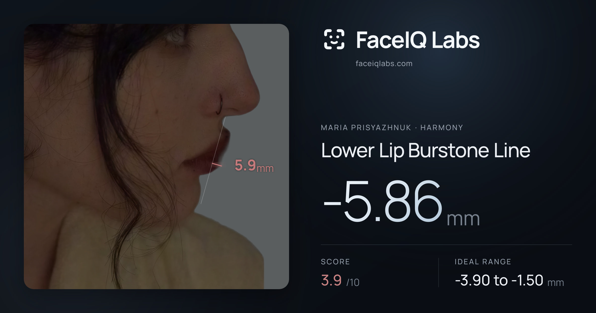 Maria Prisyazhnuk Lower Lip Burstone Line: -5.86mm, drawn on the photo