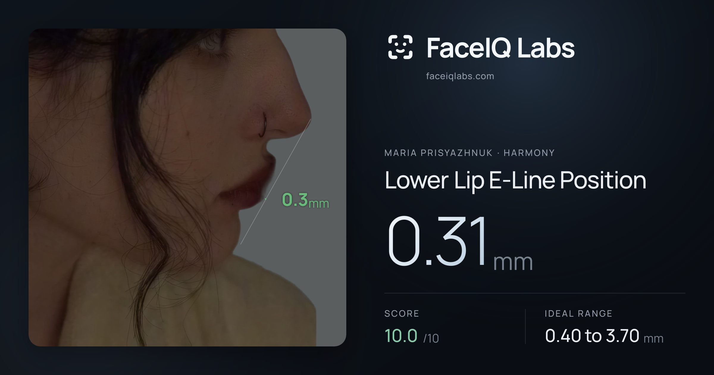 Maria Prisyazhnuk Lower Lip E-Line Position: 0.31mm, drawn on the photo