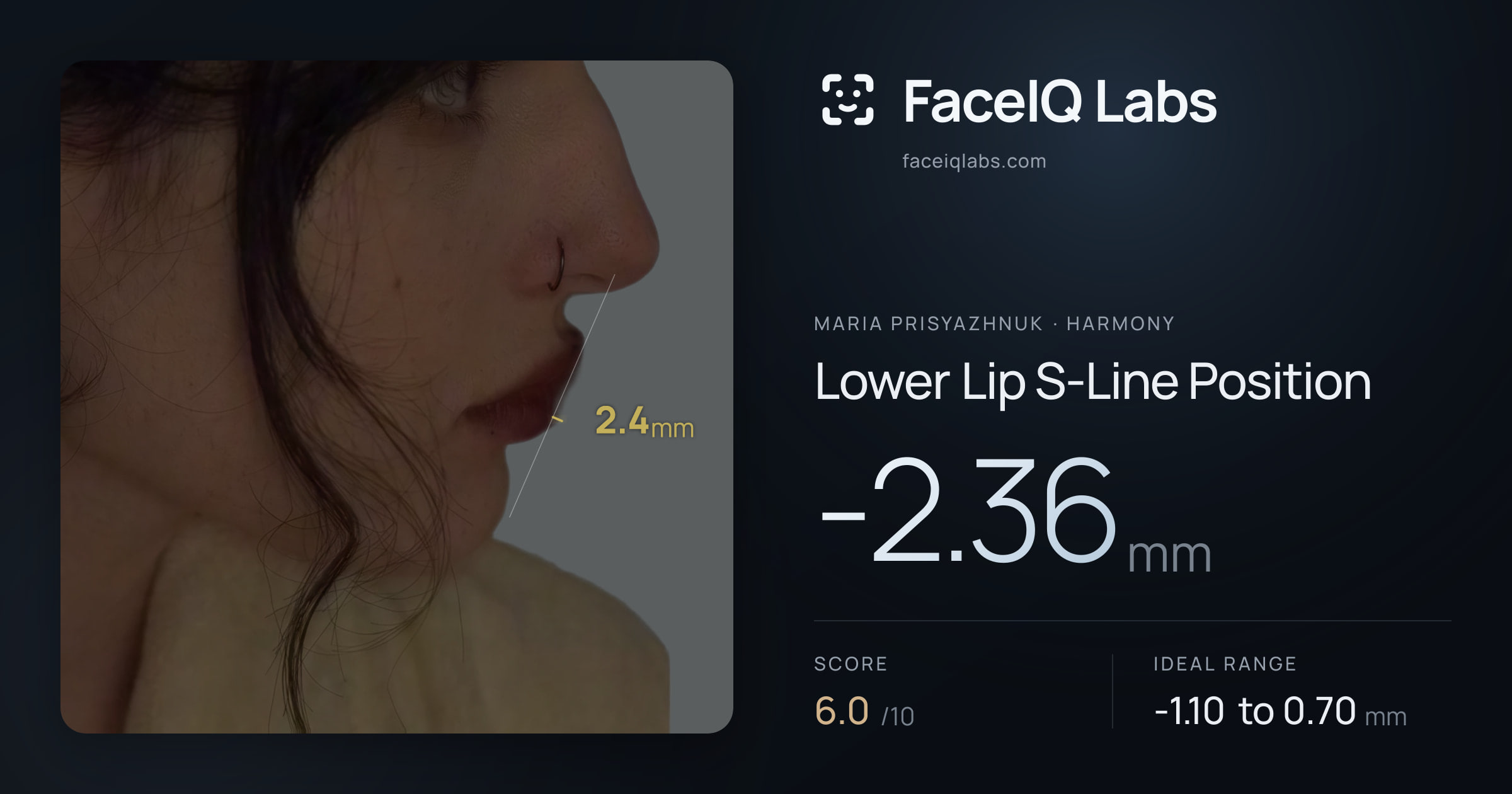 Maria Prisyazhnuk Lower Lip S-Line Position: -2.36mm, drawn on the photo