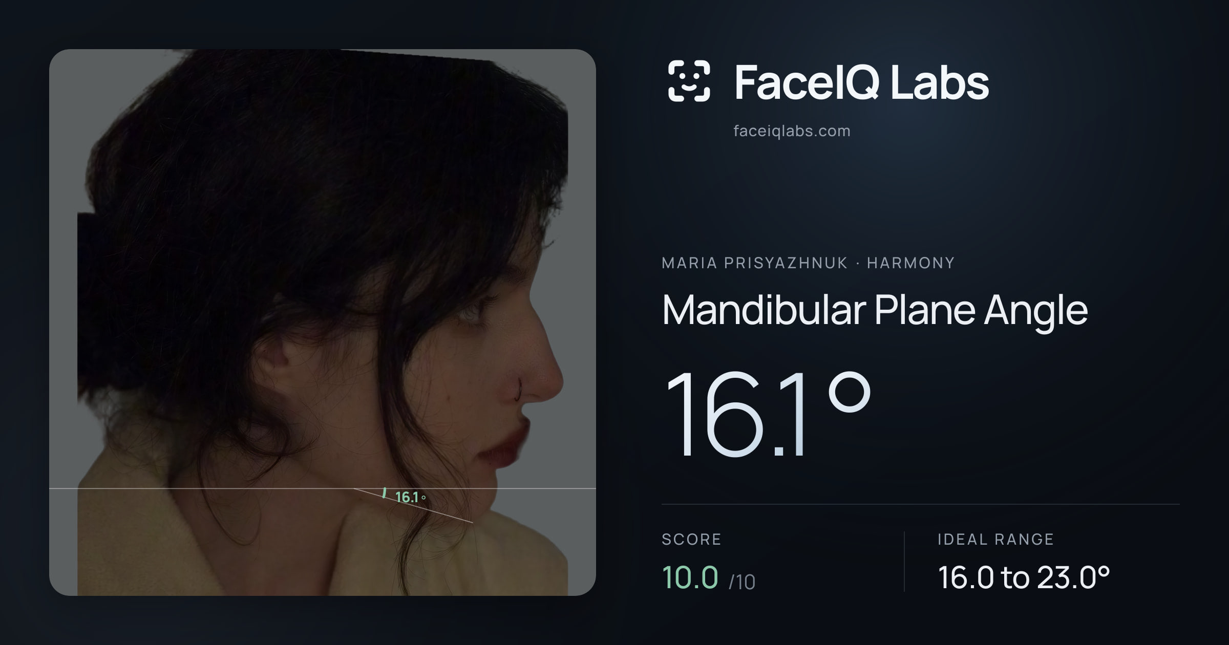 Maria Prisyazhnuk Mandibular Plane Angle: 16.1°, drawn on the photo
