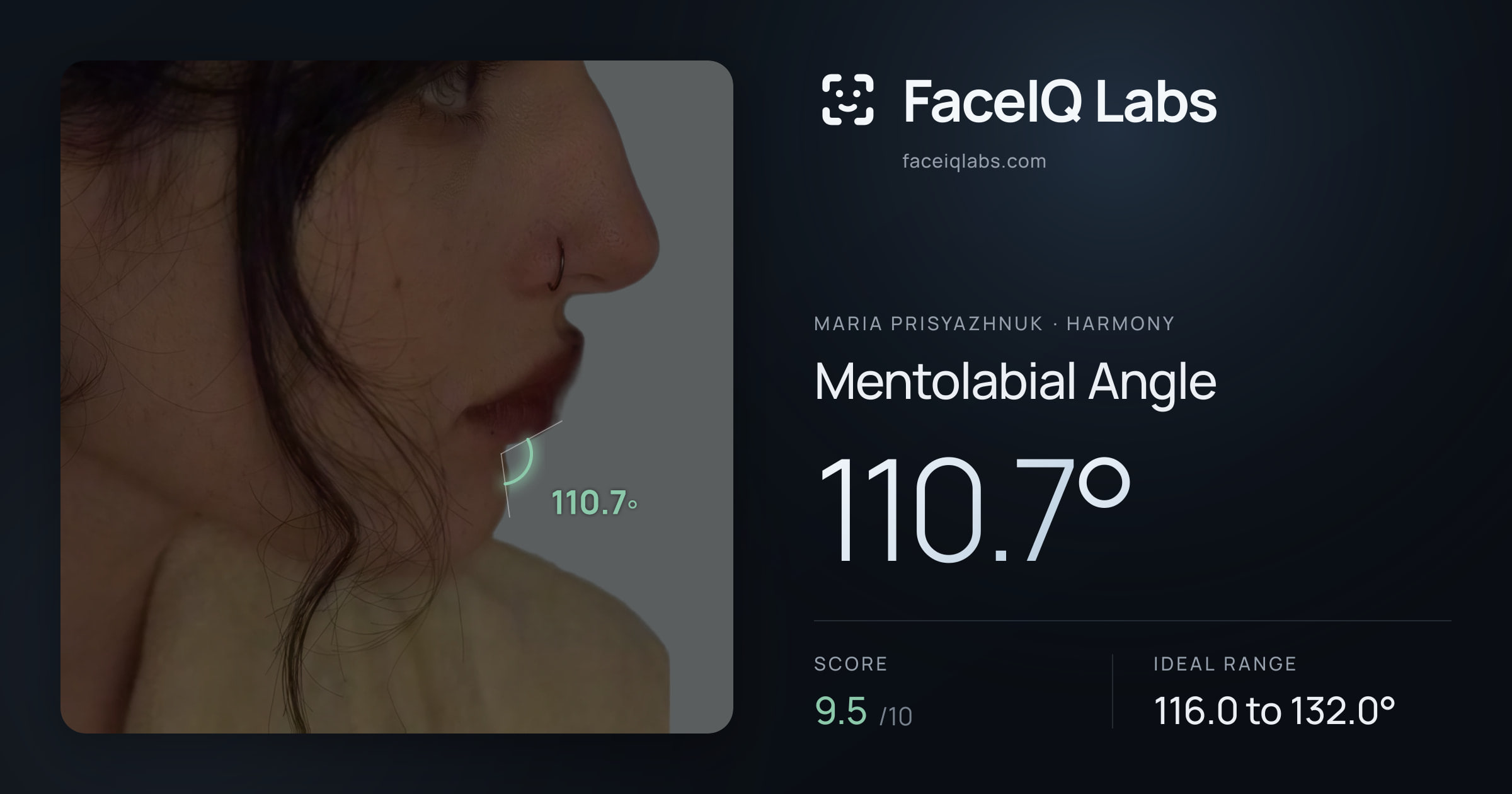 Maria Prisyazhnuk Mentolabial Angle: 110.7°, drawn on the photo