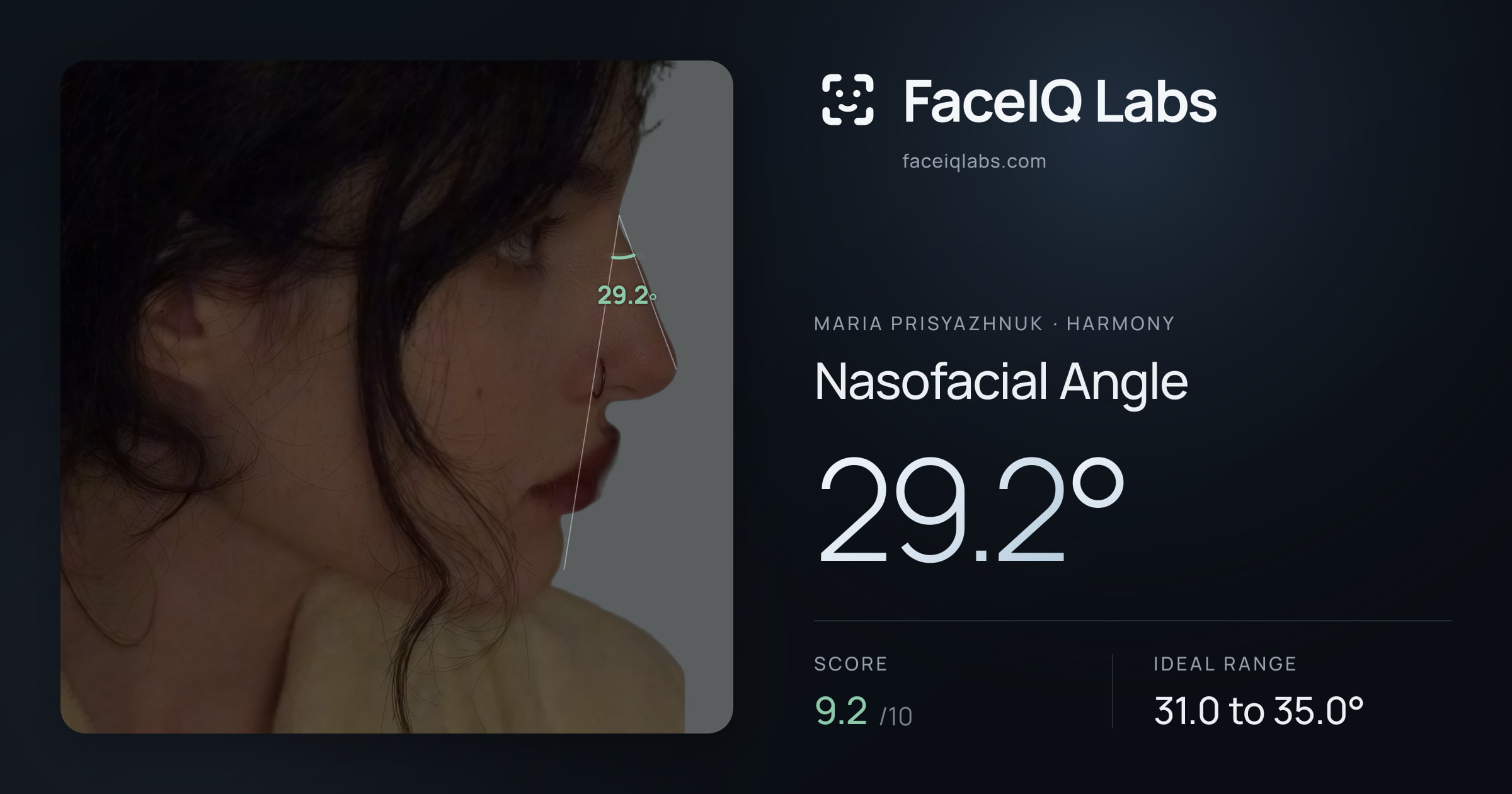 Maria Prisyazhnuk Nasofacial Angle: 29.2°, drawn on the photo