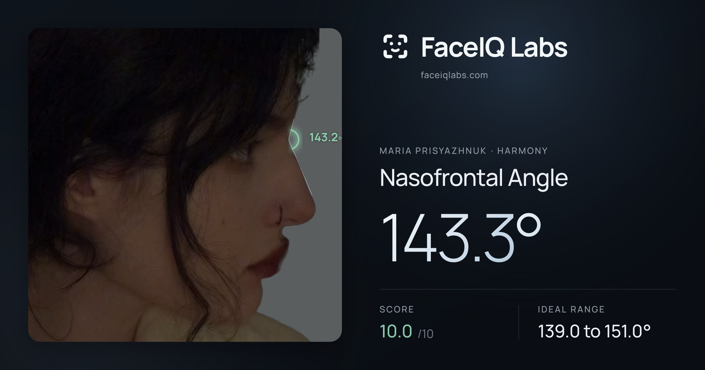 Maria Prisyazhnuk Nasofrontal Angle: 143.3°, drawn on the photo